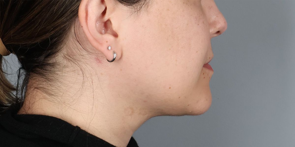 Submental liposuction after — three-quarter view, Dr. Beina Azadgoli, Beverly Hills