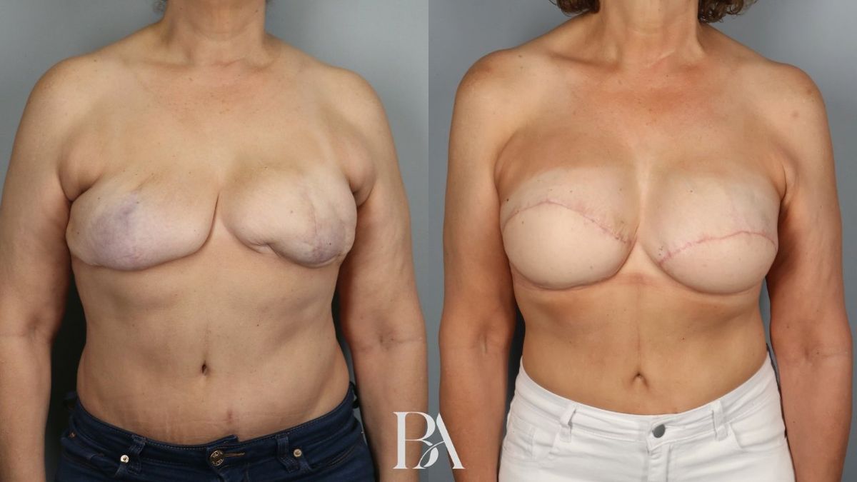Before and after — Breast Reconstruction Revision