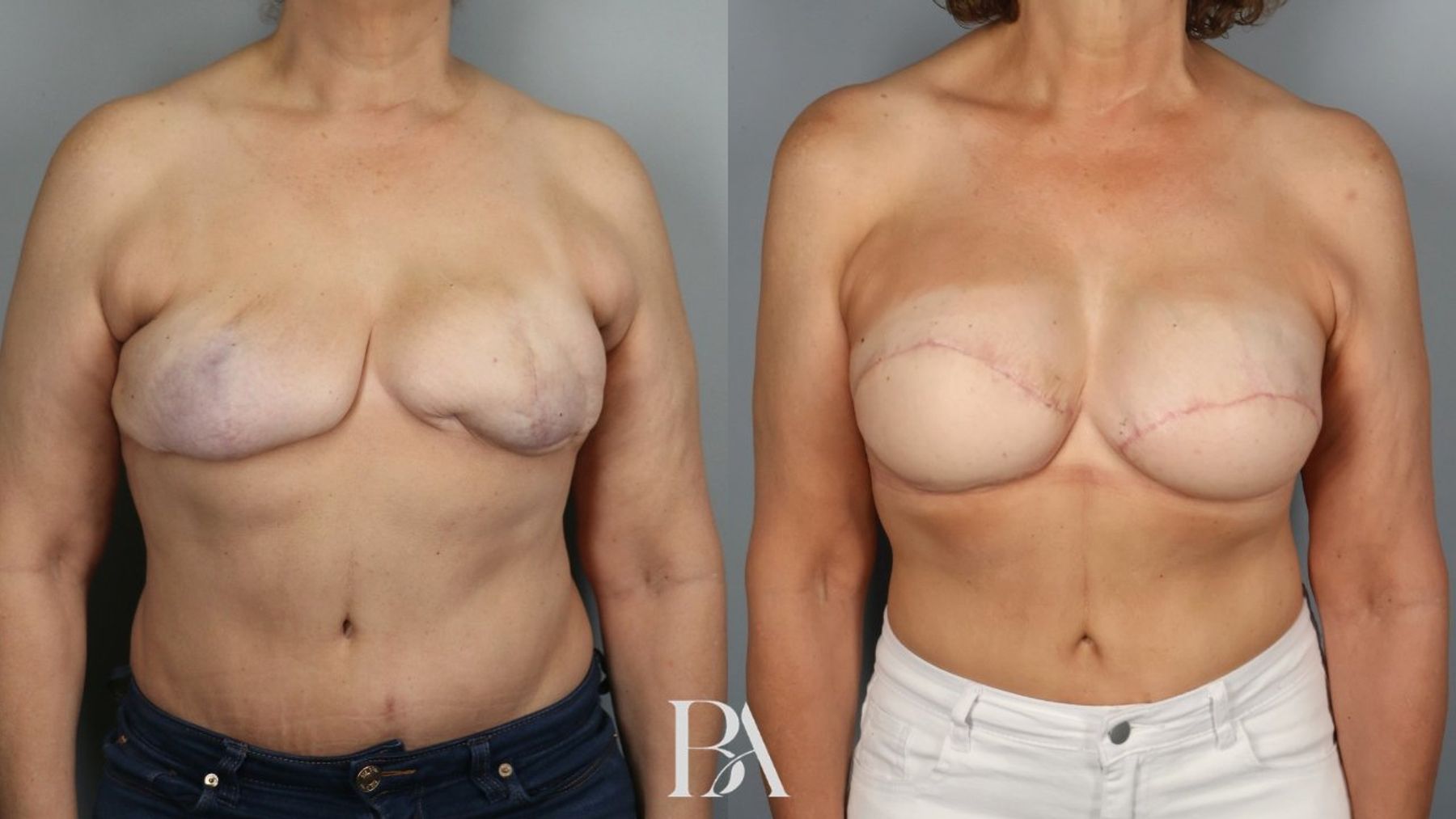 Breast Reconstruction Revision before and after — front view, Dr. Beina Azadgoli, Beverly Hills