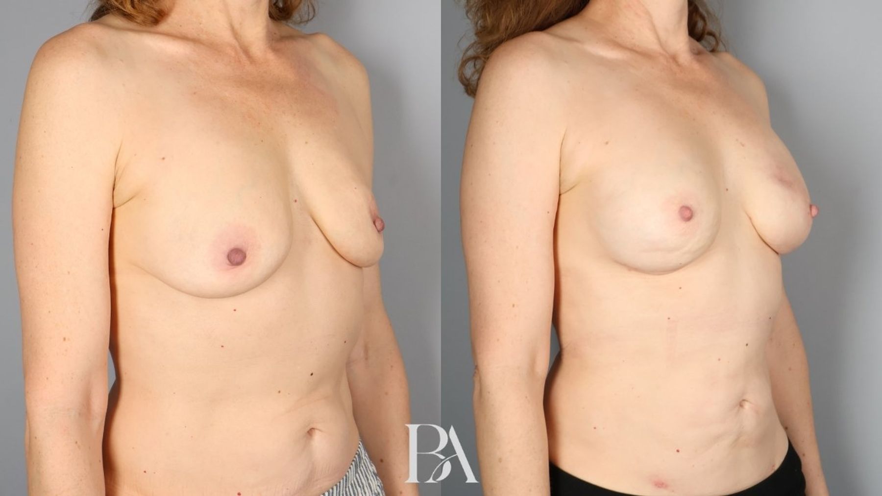 Direct-to-Implant Reconstruction before and after — oblique view, Dr. Beina Azadgoli, Beverly Hills