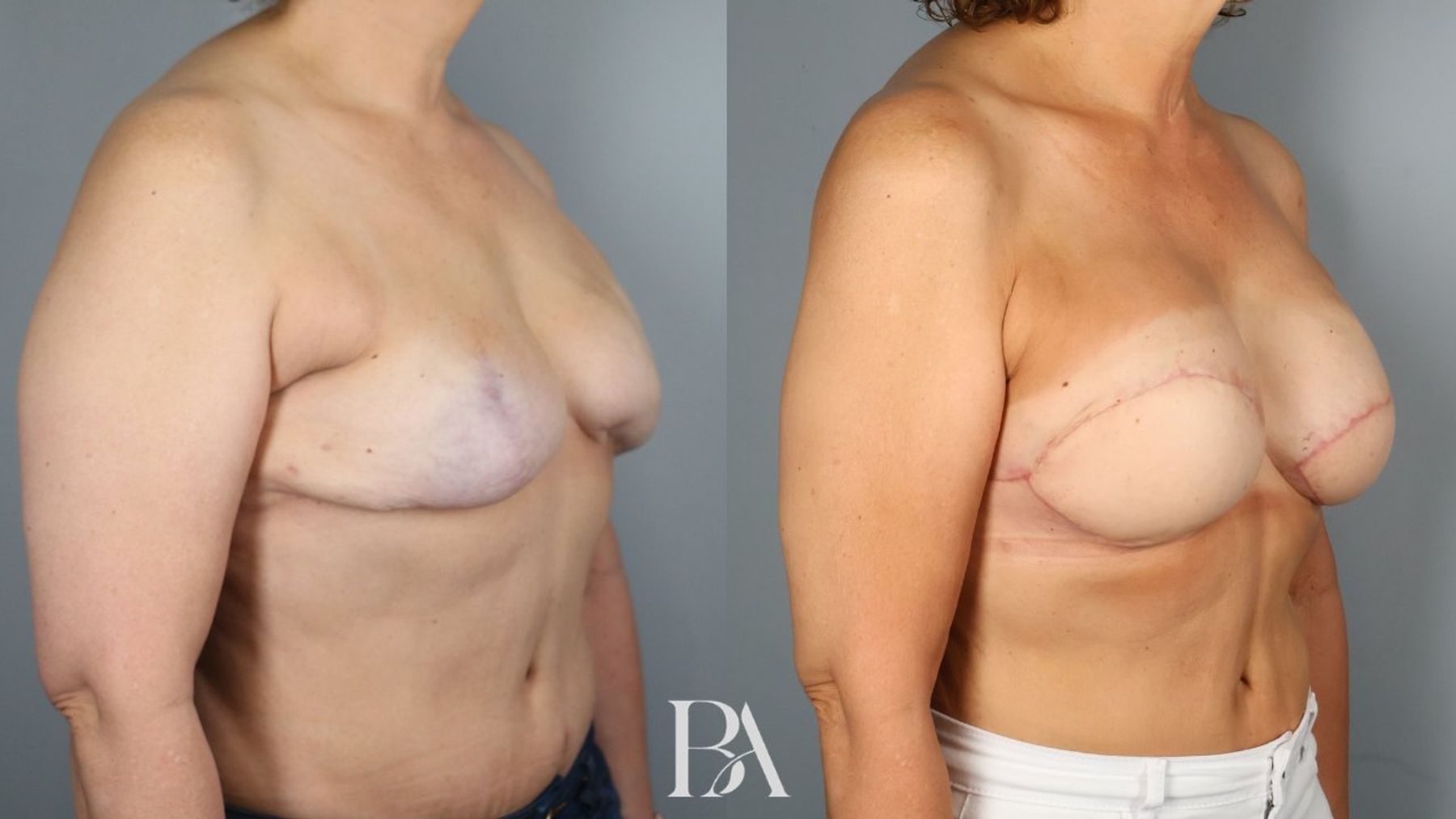 Breast Reconstruction Revision before and after — oblique view, Dr. Beina Azadgoli, Beverly Hills