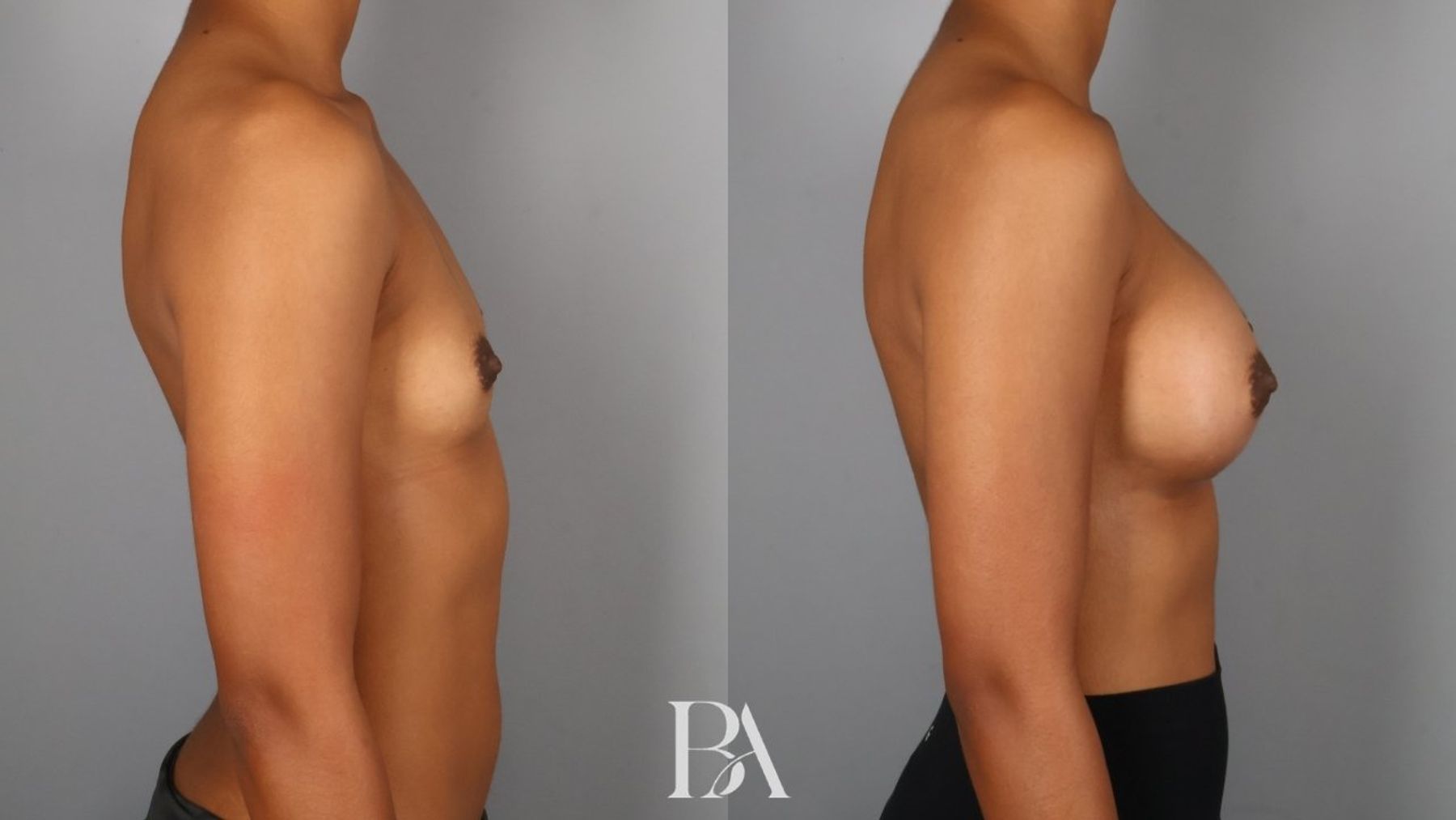 Breast augmentation before and after — side view, Dr. Beina Azadgoli, Beverly Hills