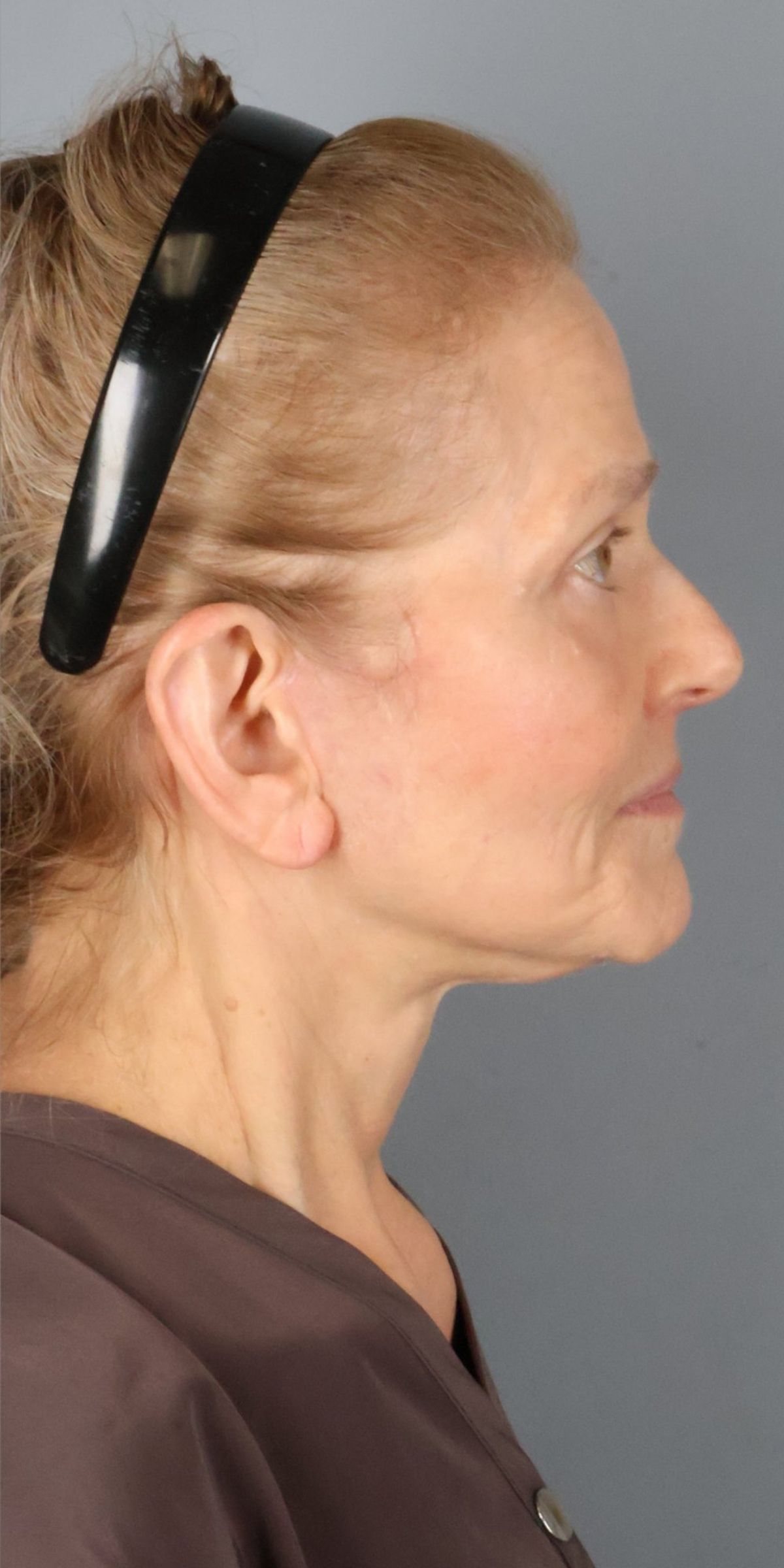 Face/neck lift after — side view, Dr. Beina Azadgoli, Beverly Hills