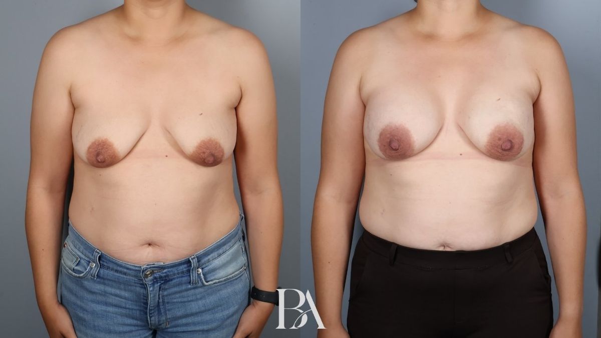 Before and after — Direct-to-Implant Reconstruction