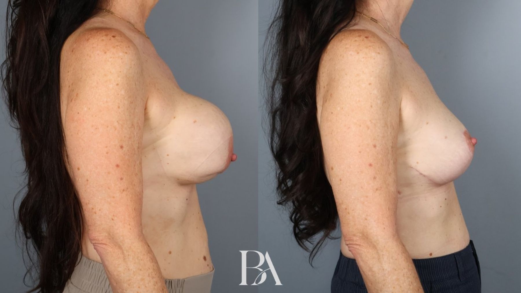 Implant Removal and Replacement before and after — side view, Dr. Beina Azadgoli, Beverly Hills