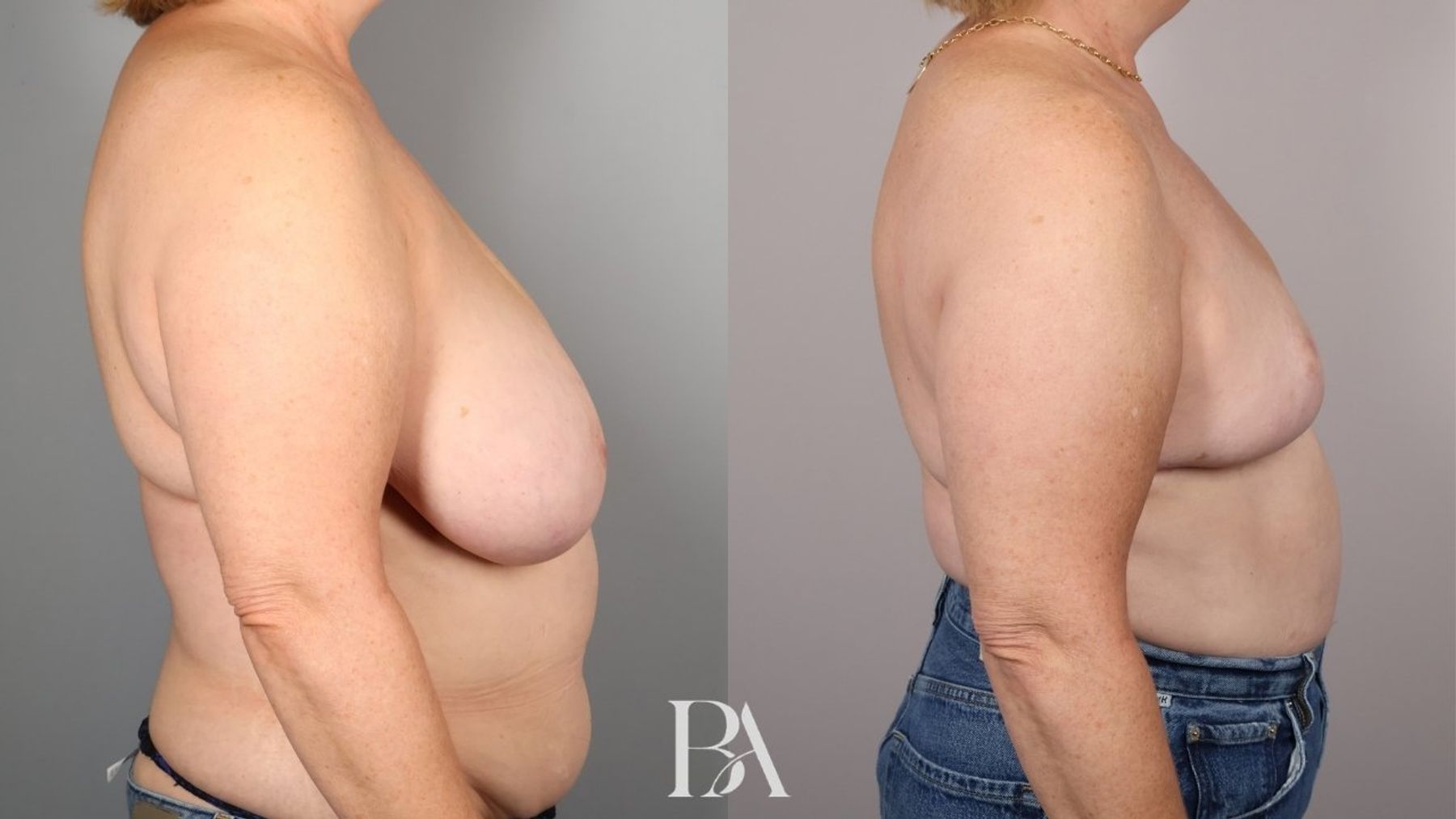 Breast reduction before and after — side view, Dr. Beina Azadgoli, Beverly Hills