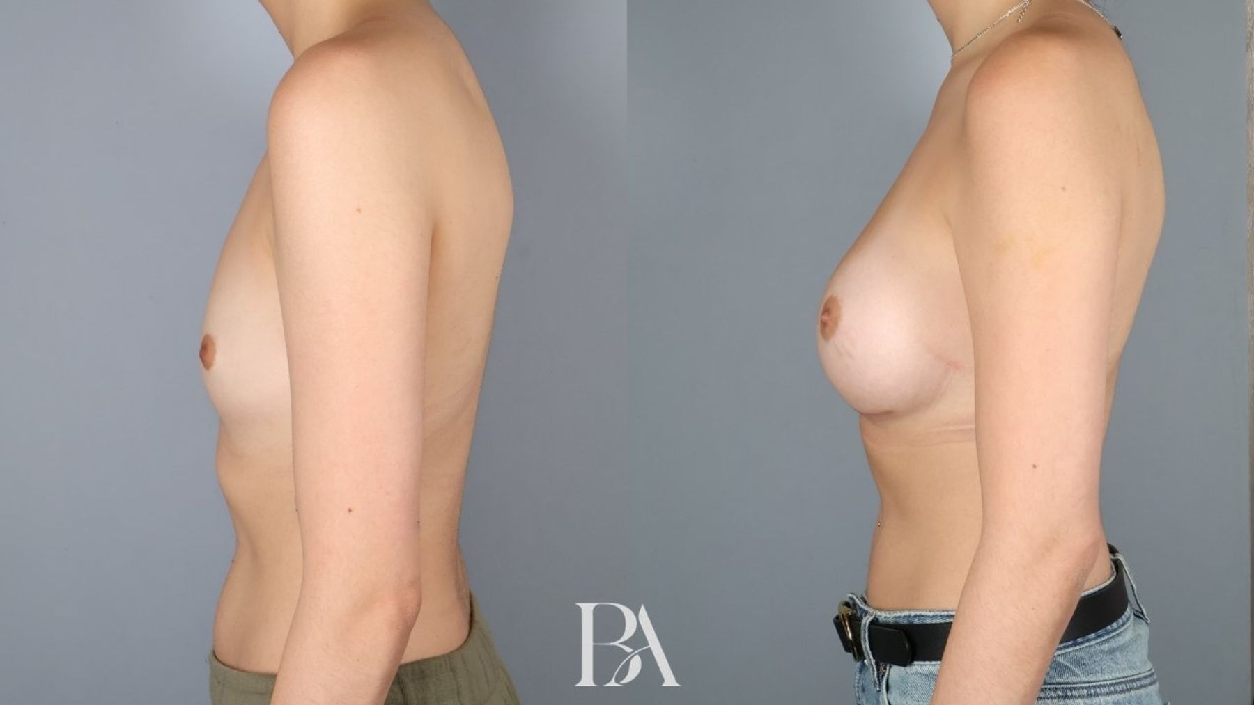 Breast augmentation before and after — side view, Dr. Beina Azadgoli, Beverly Hills