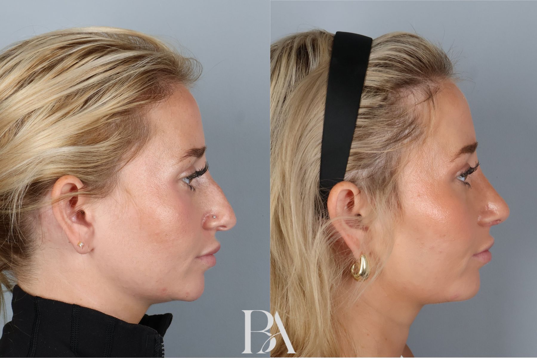 Rhinoplasty before and after — oblique view, Dr. Beina Azadgoli, Beverly Hills