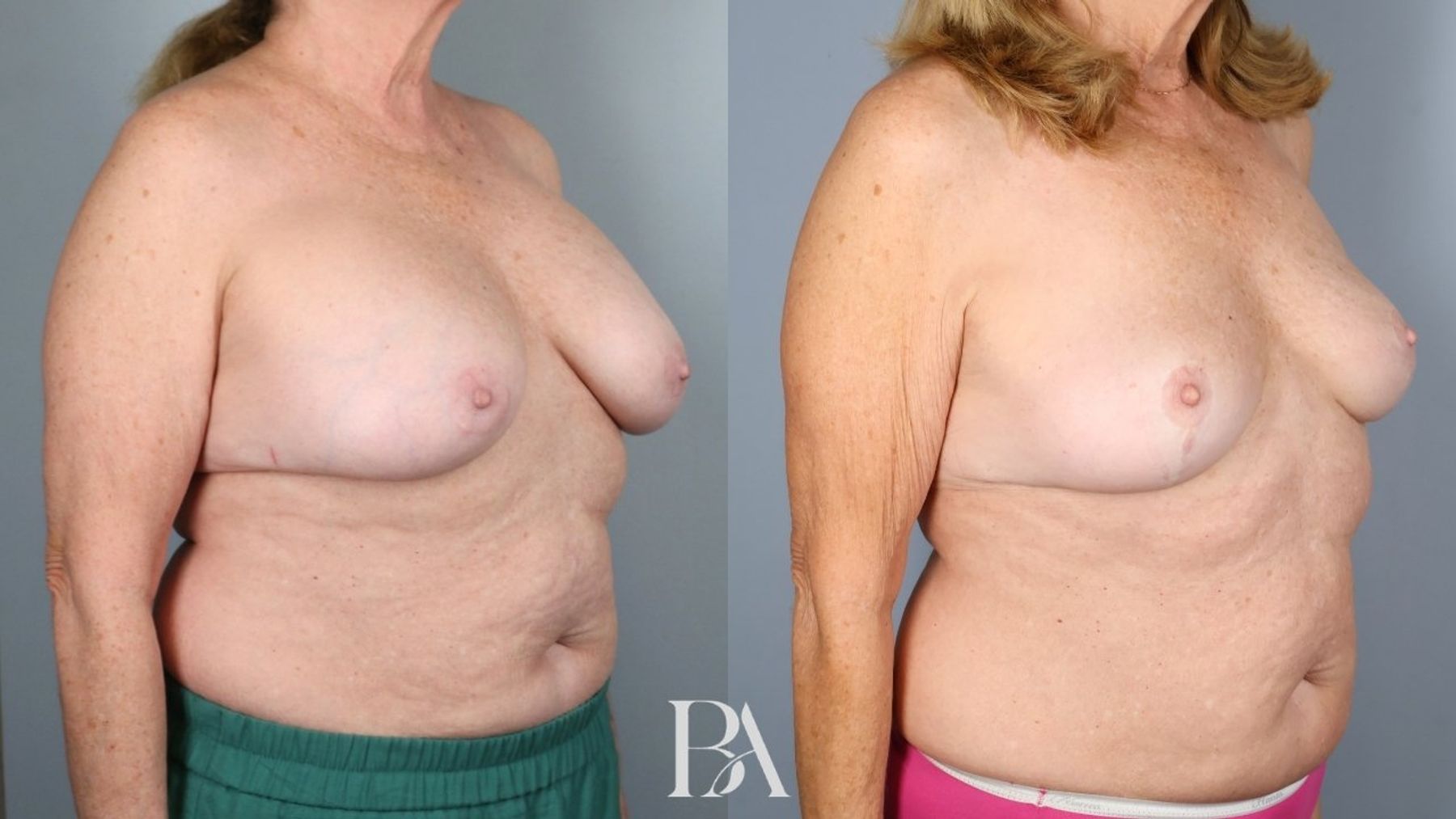 Breast implant removal before and after — oblique view, Dr. Beina Azadgoli, Beverly Hills