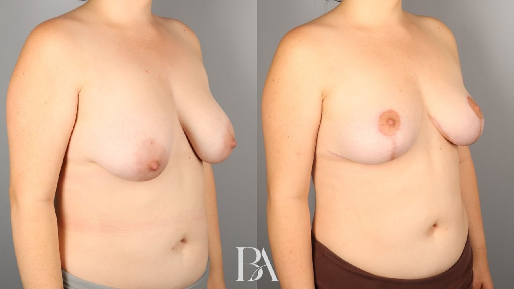 Breast lift before and after — oblique view, Dr. Beina Azadgoli, Beverly Hills