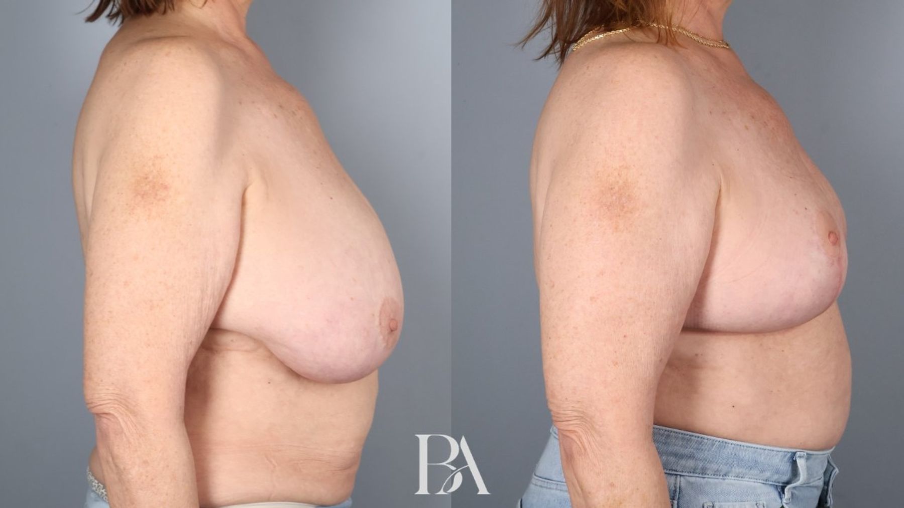 Breast reduction before and after — side view, Dr. Beina Azadgoli, Beverly Hills