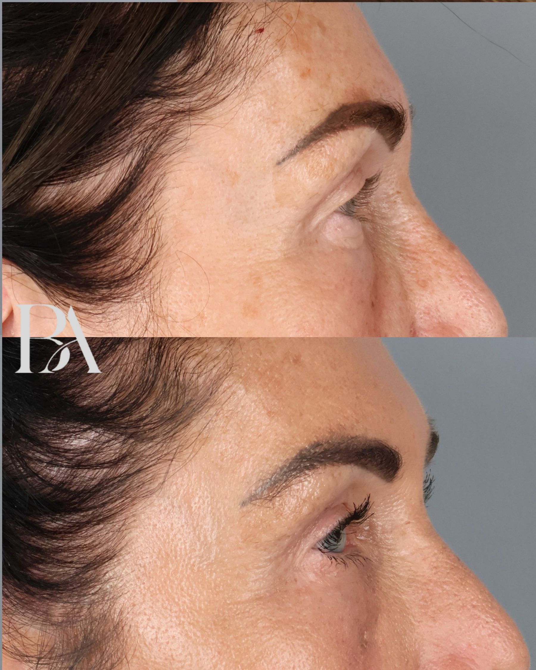 Upper Blepharoplasty before and after — side view, Dr. Beina Azadgoli, Beverly Hills