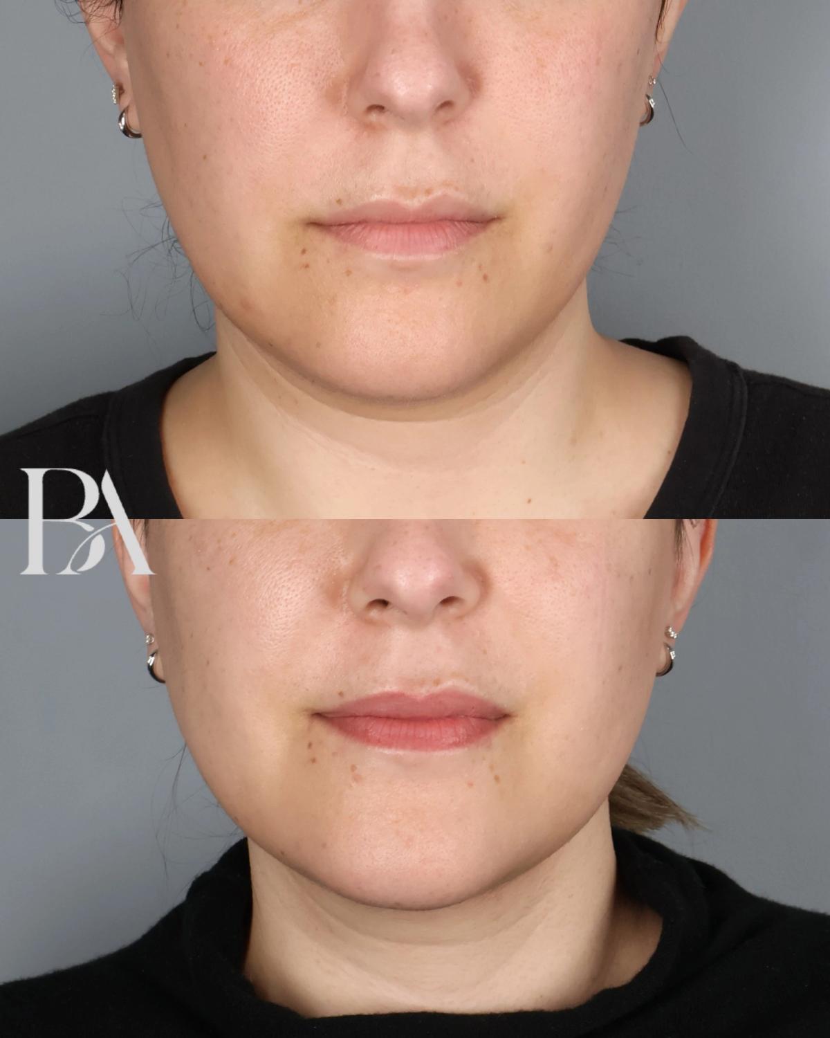 Submental Liposuction before and after — front view, Dr. Beina Azadgoli, Beverly Hills