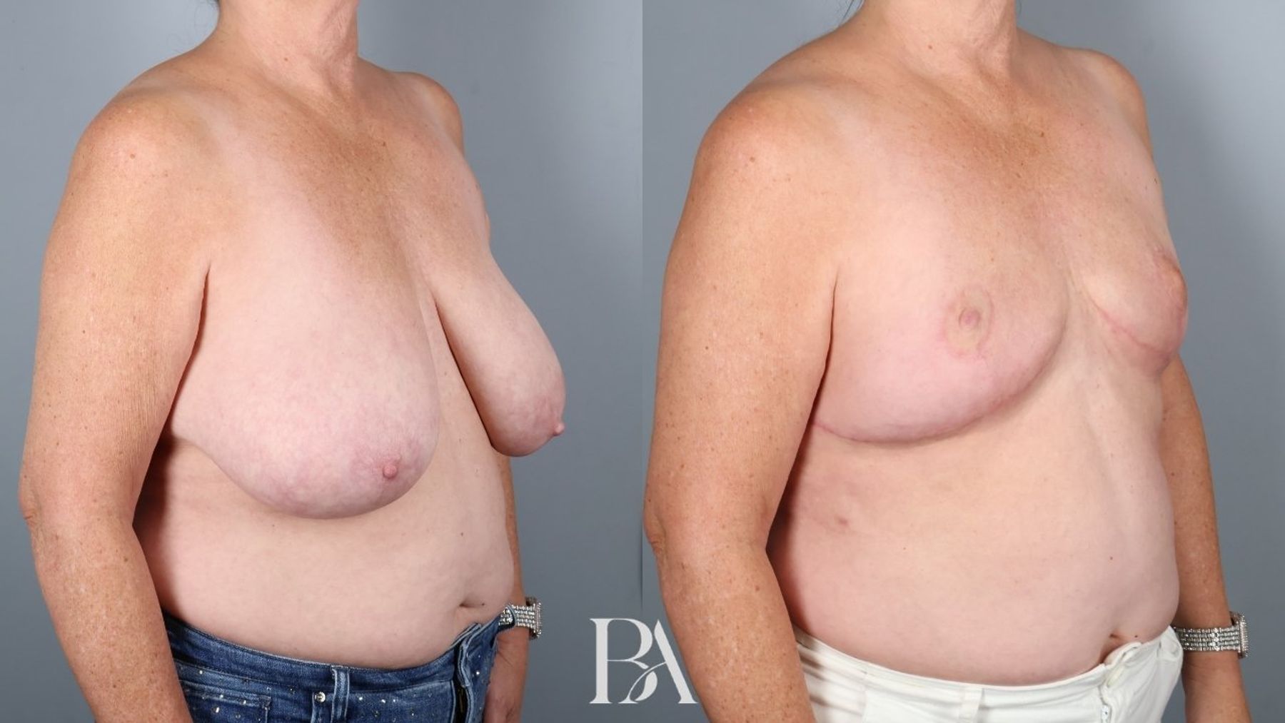 SWIM Flap Reconstruction before and after — oblique view, Dr. Beina Azadgoli, Beverly Hills