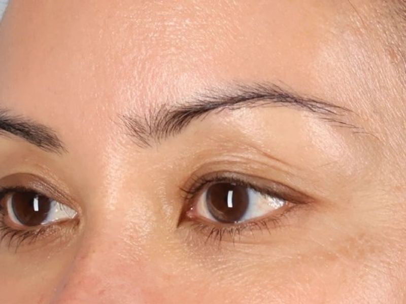Before — Upper Blepharoplasty