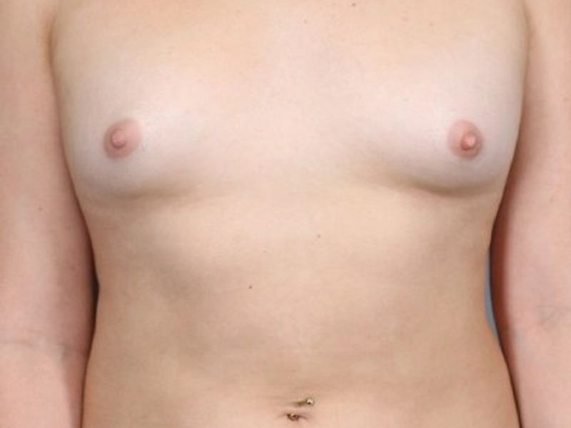 Before — Breast Augmentation