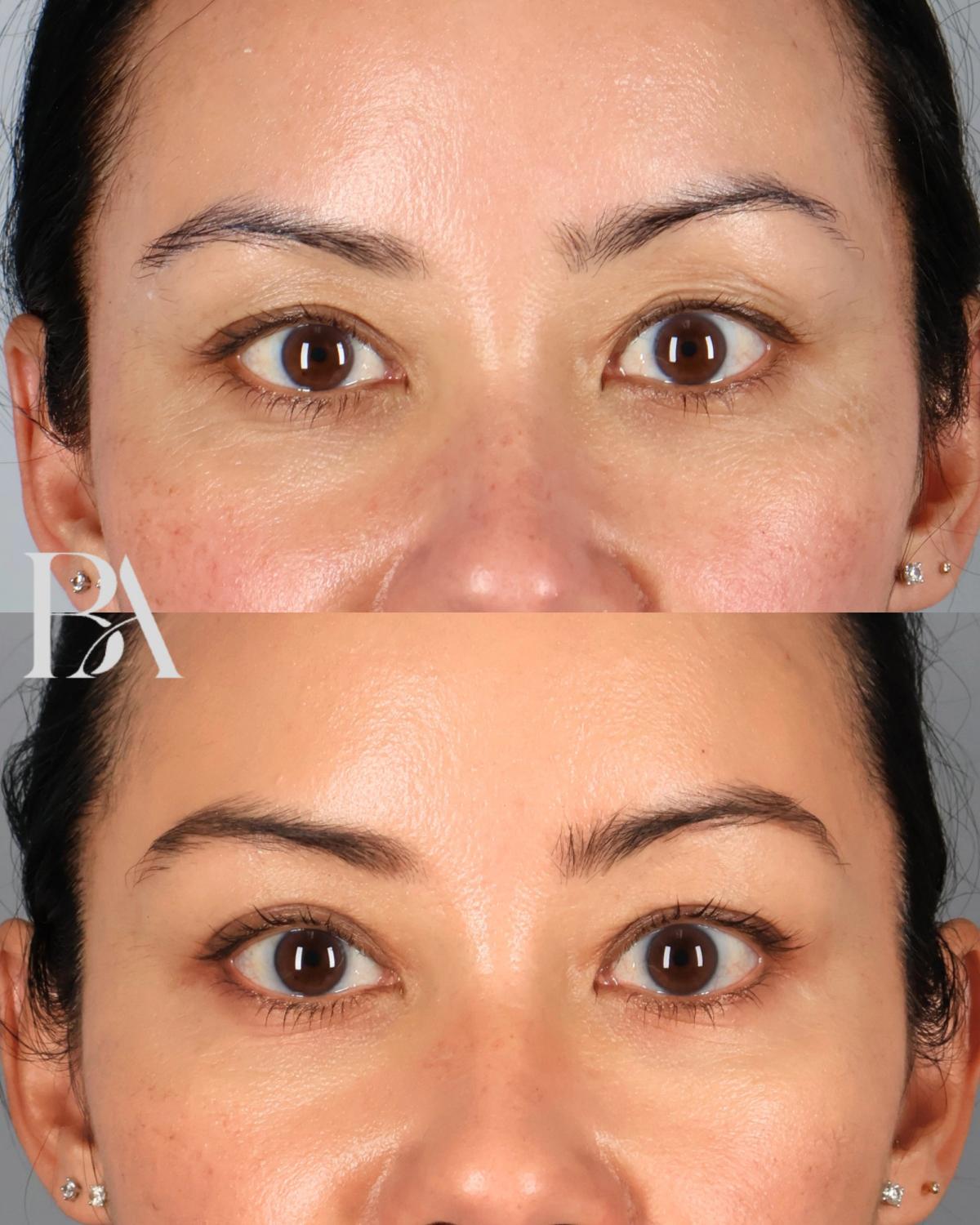 Upper Blepharoplasty before and after — front view, Dr. Beina Azadgoli, Beverly Hills