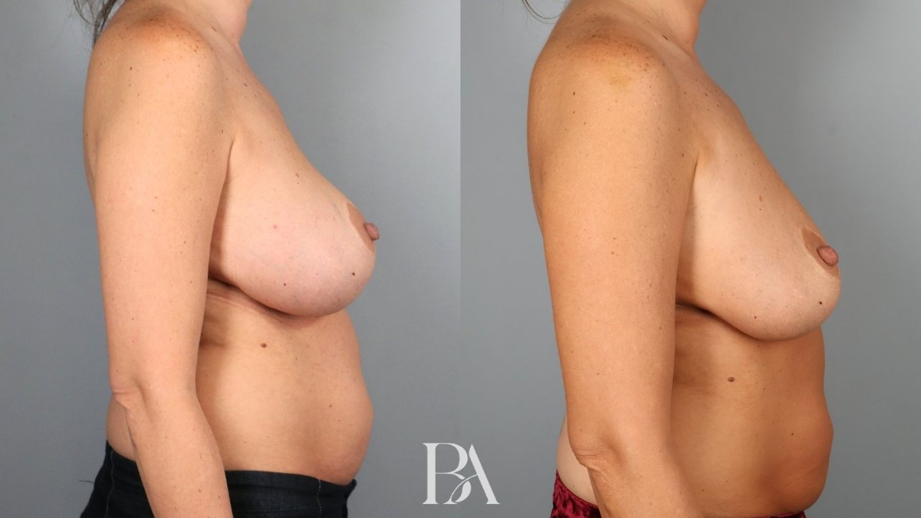 Breast implant removal before and after — side view, Dr. Beina Azadgoli, Beverly Hills