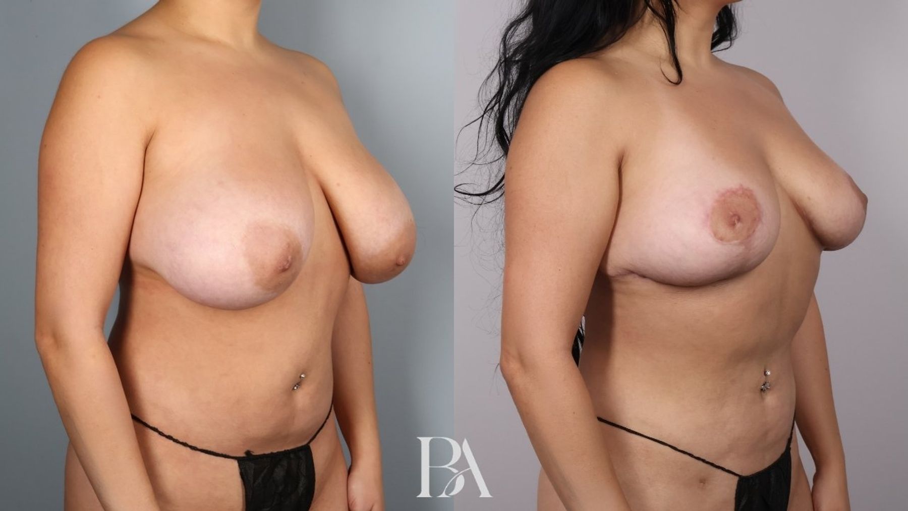 Breast reduction before and after — oblique view, Dr. Beina Azadgoli, Beverly Hills