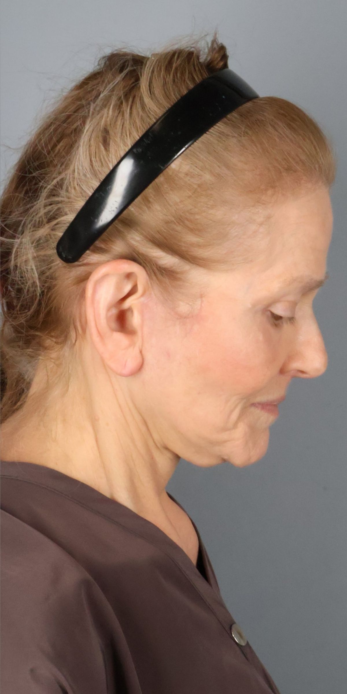 Face/neck lift after — detail view, Dr. Beina Azadgoli, Beverly Hills