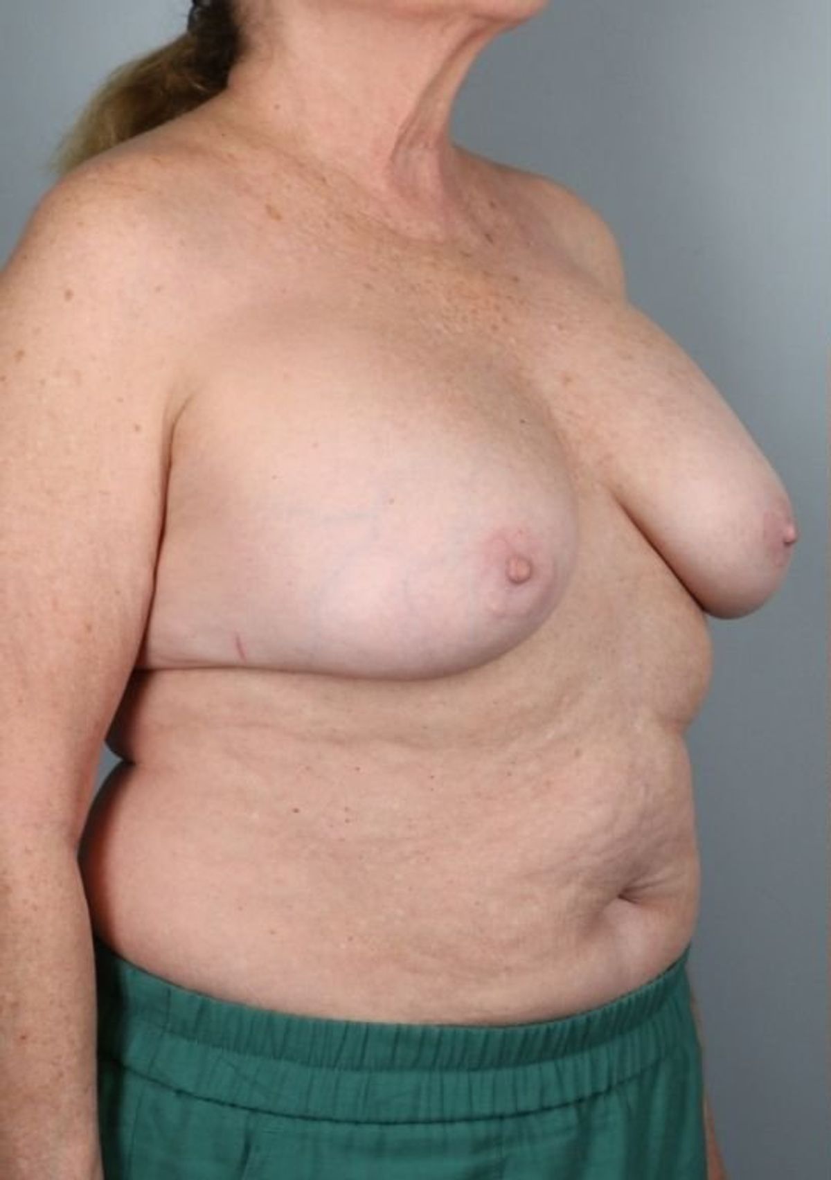 Breast implant removal before — three-quarter view, Dr. Beina Azadgoli, Beverly Hills