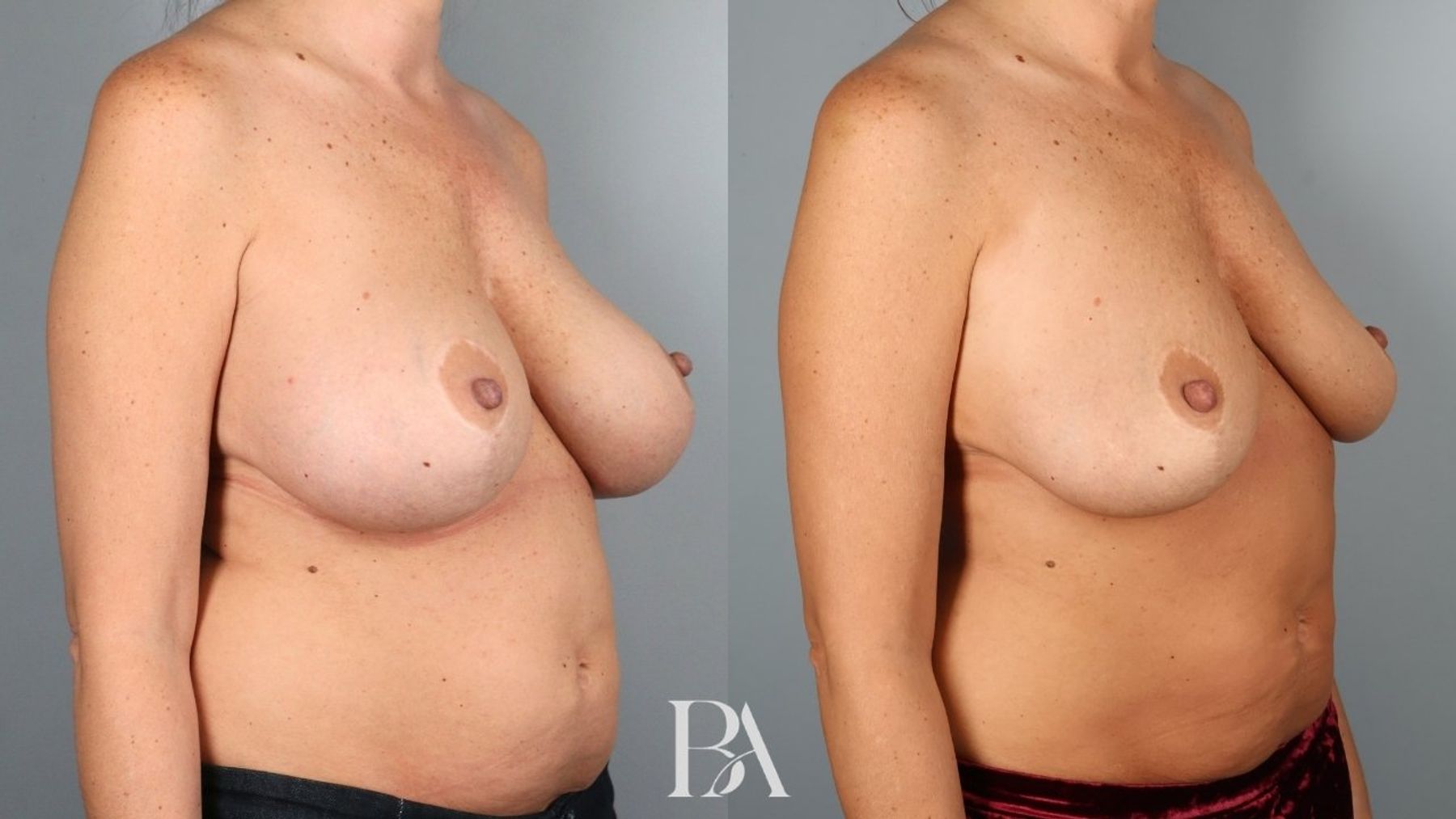 Breast implant removal before and after — oblique view, Dr. Beina Azadgoli, Beverly Hills