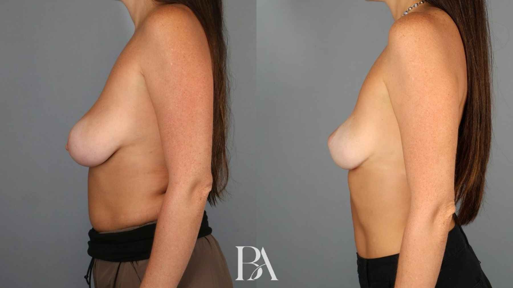 Breast lift before and after — side view, Dr. Beina Azadgoli, Beverly Hills
