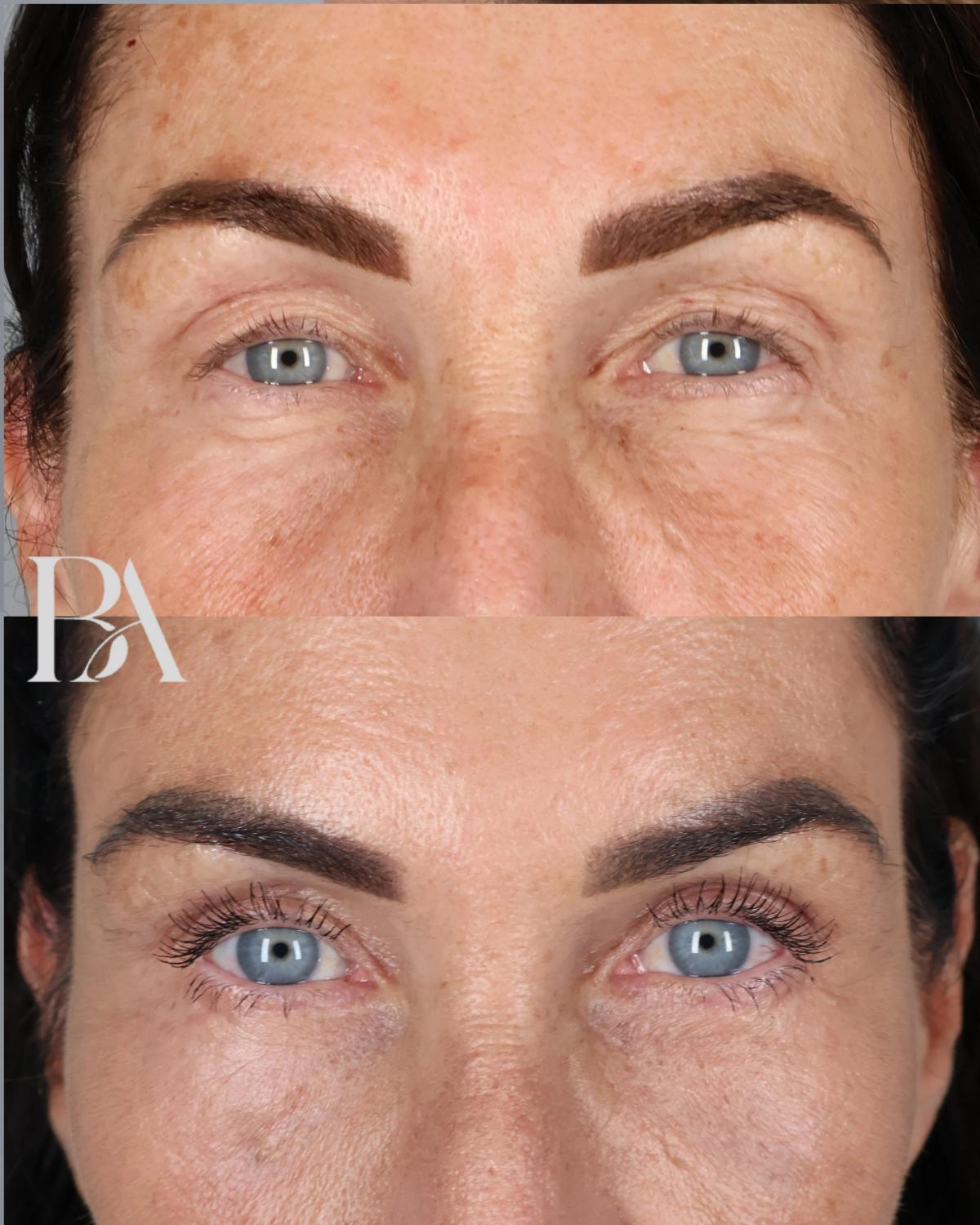 Before and after — Upper Blepharoplasty