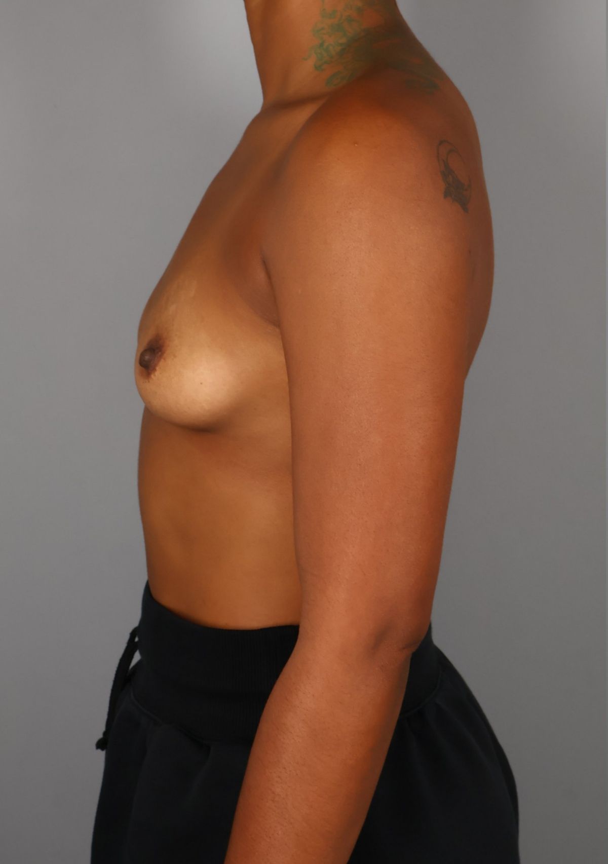 Breast augmentation before — three-quarter view, Dr. Beina Azadgoli, Beverly Hills