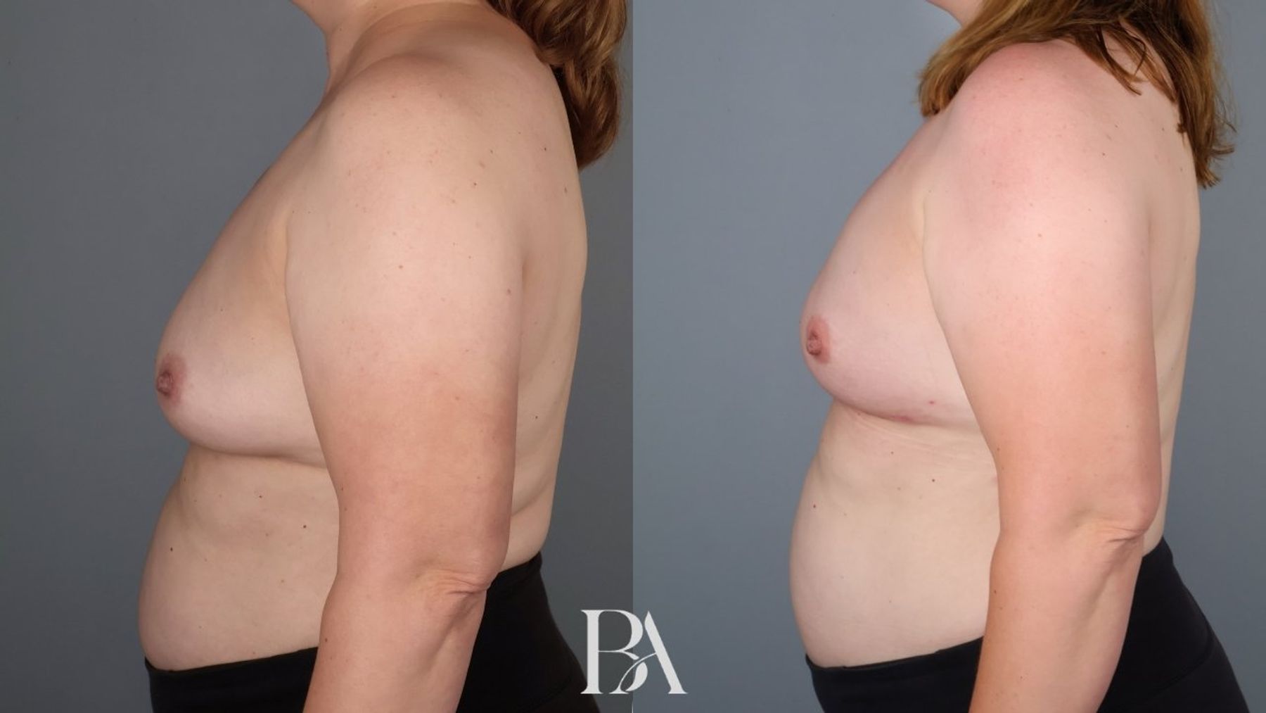 Direct-to-Implant Reconstruction before and after — side view, Dr. Beina Azadgoli, Beverly Hills