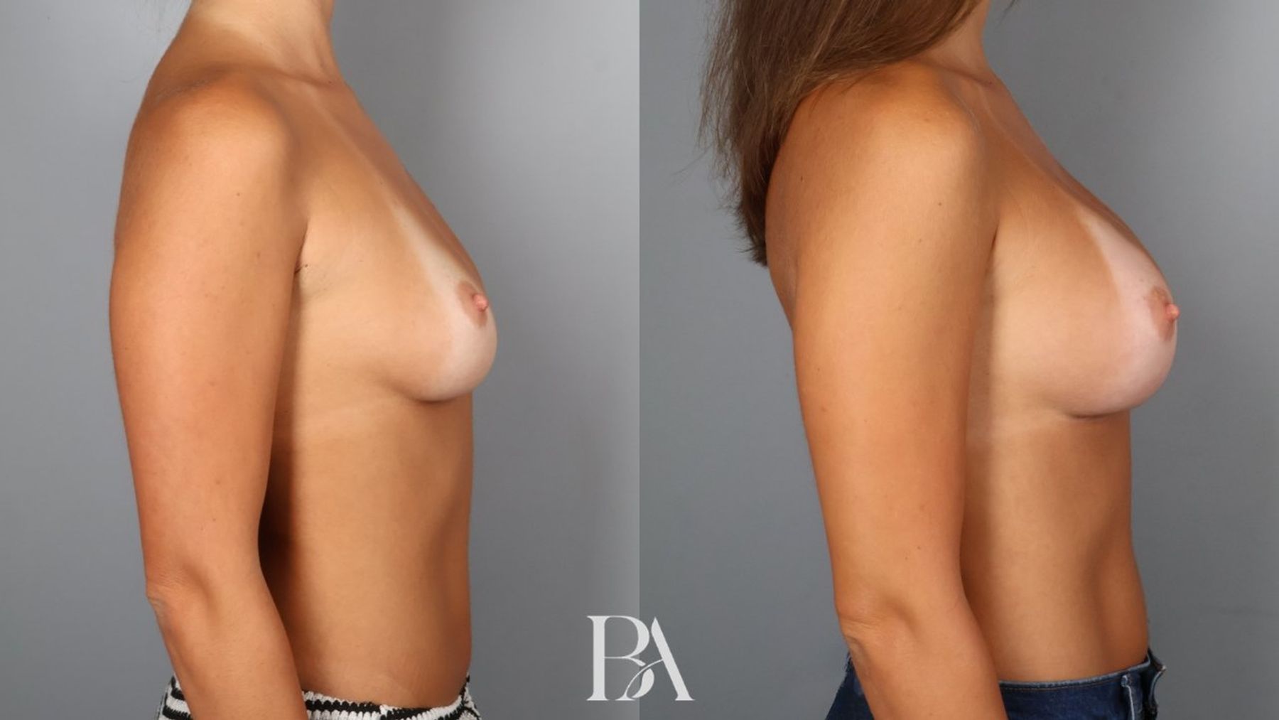 Breast augmentation before and after — side view, Dr. Beina Azadgoli, Beverly Hills