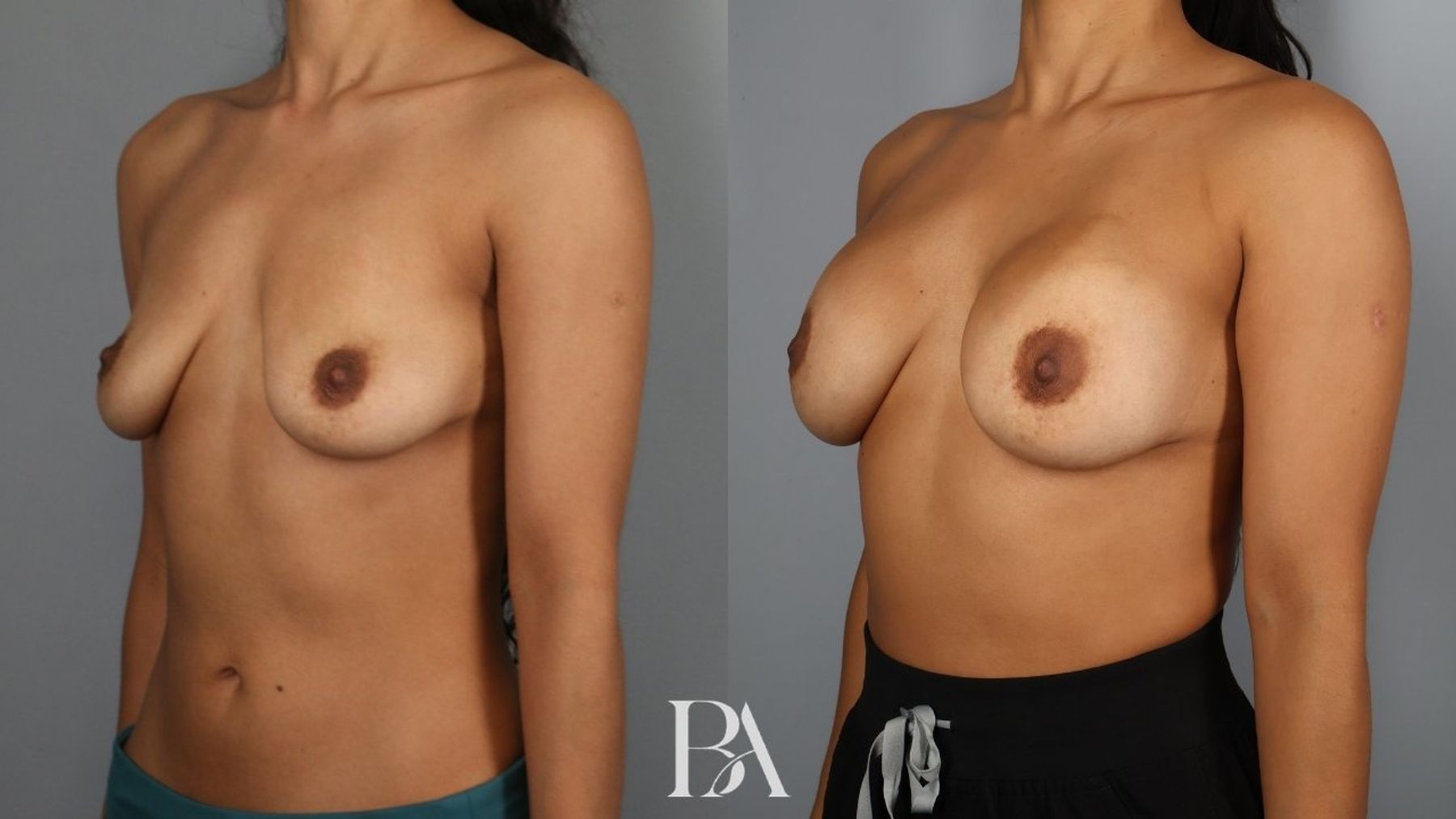 Breast augmentation before and after — three-quarter view, Dr. Beina Azadgoli, Beverly Hills