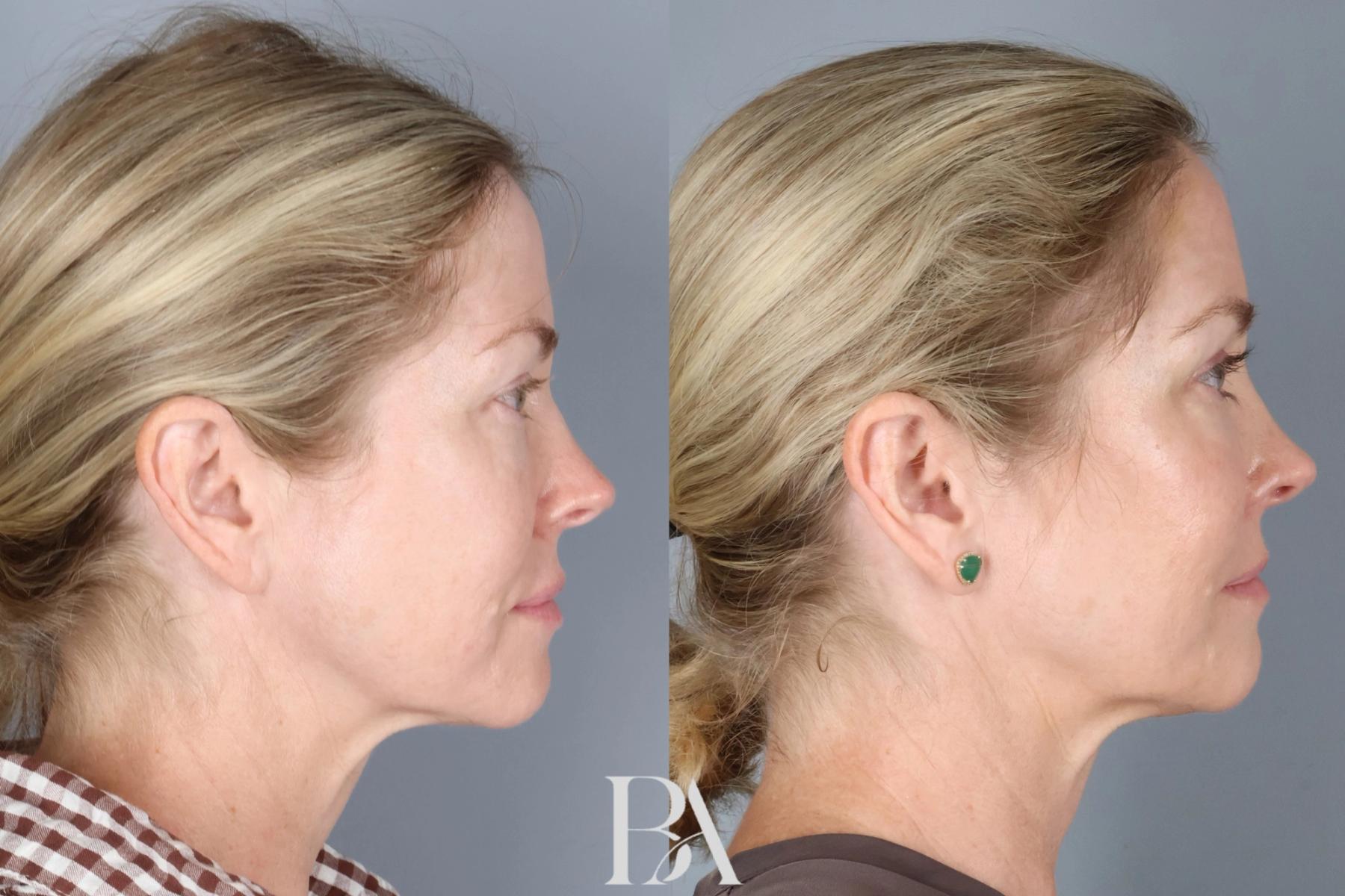 Upper Blepharoplasty before and after — side view, Dr. Beina Azadgoli, Beverly Hills