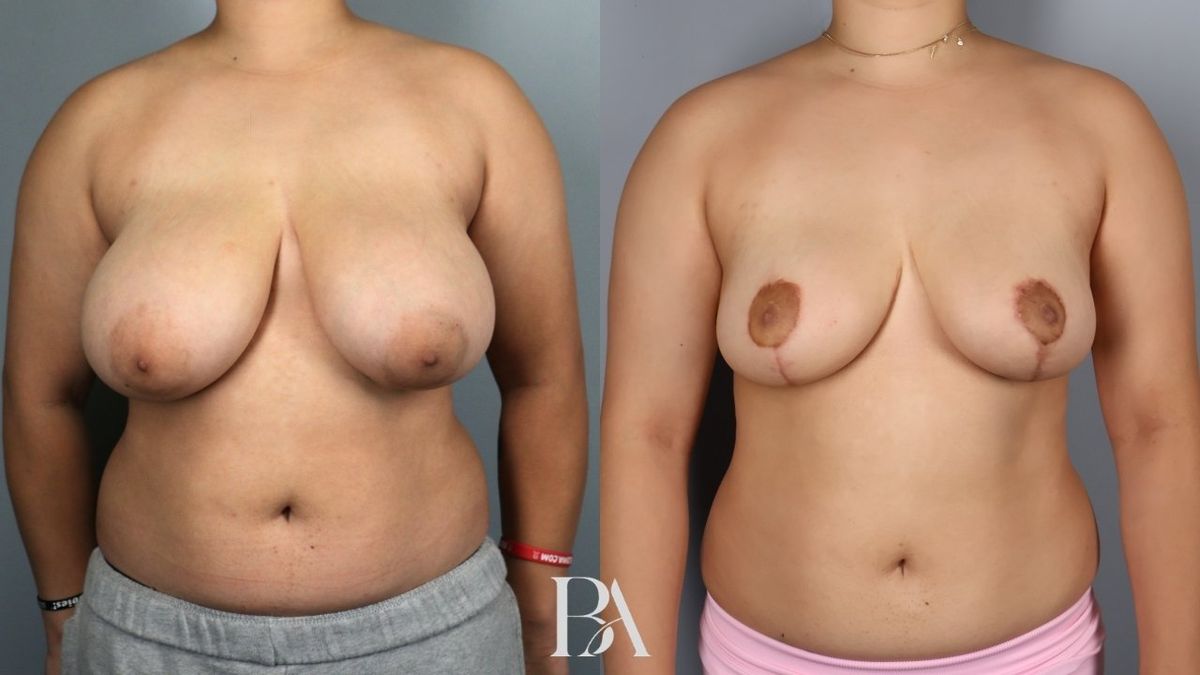 Breast reduction before and after — front view, Dr. Beina Azadgoli, Beverly Hills
