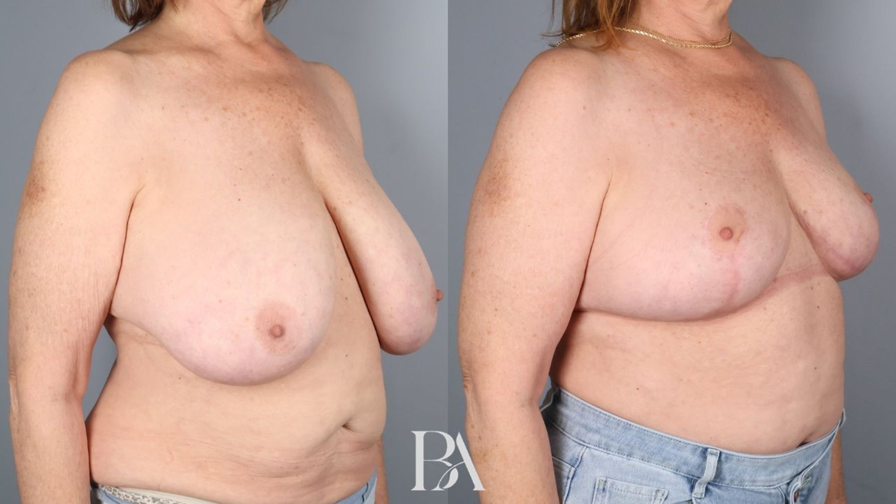 Breast reduction before and after — oblique view, Dr. Beina Azadgoli, Beverly Hills