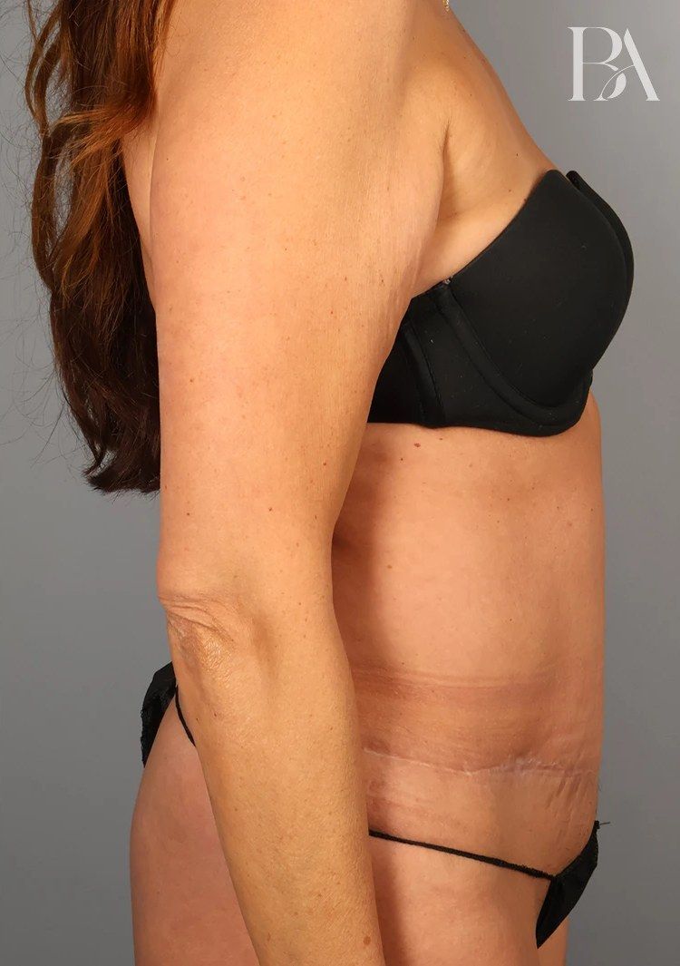 After — Tummy Tuck (Abdominoplasty)