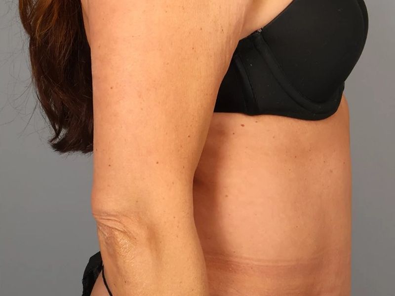 After — Tummy Tuck (Abdominoplasty)