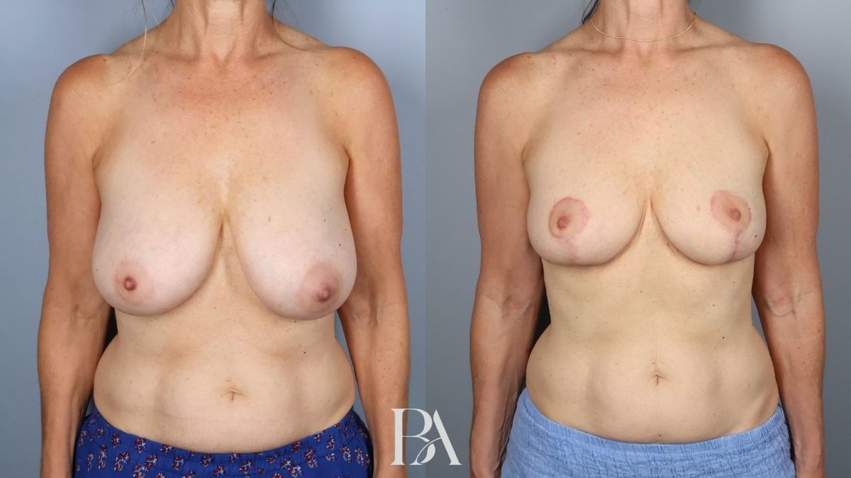 Before and after — Breast Reduction