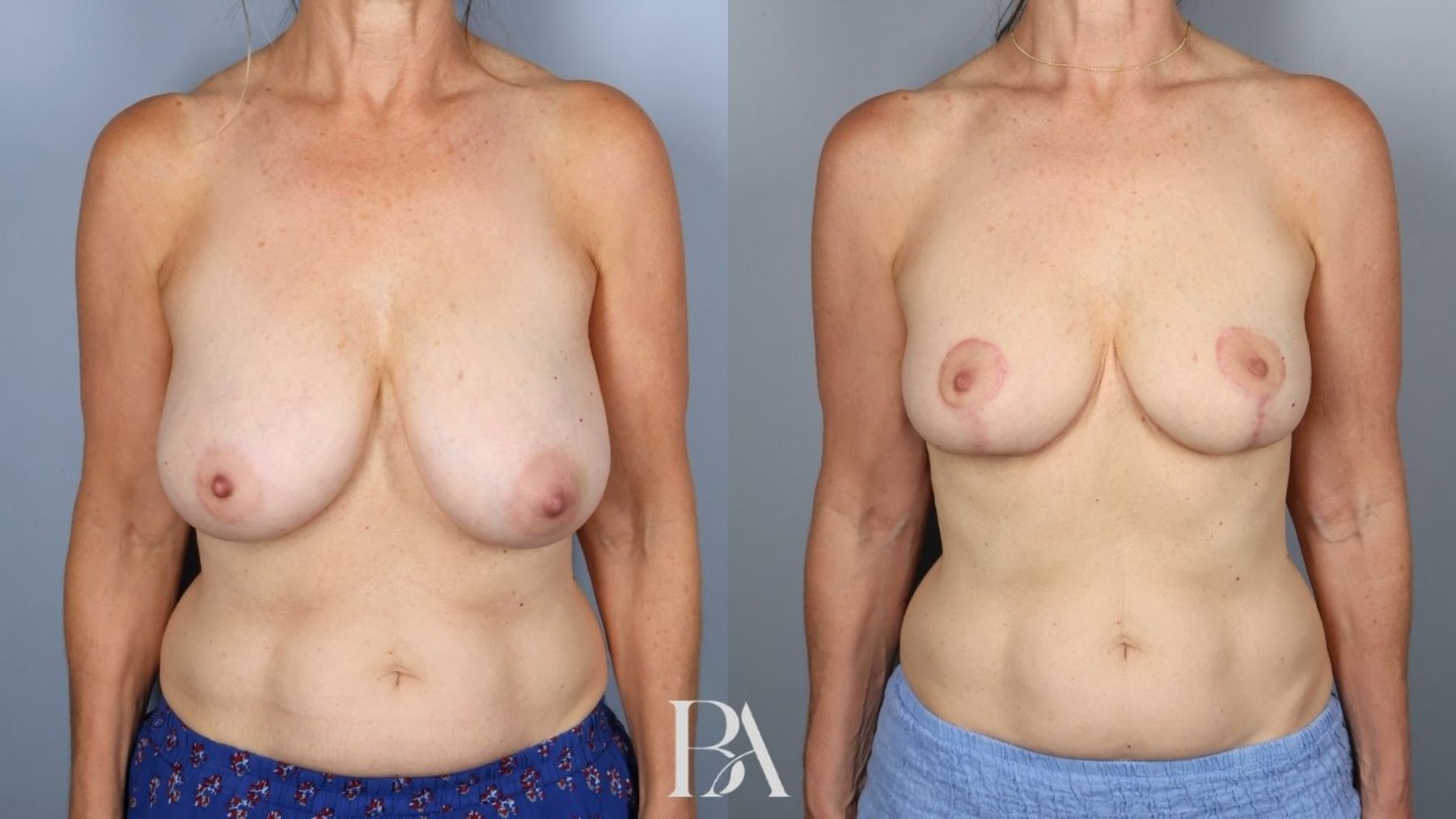 Breast reduction before and after — front view, Dr. Beina Azadgoli, Beverly Hills