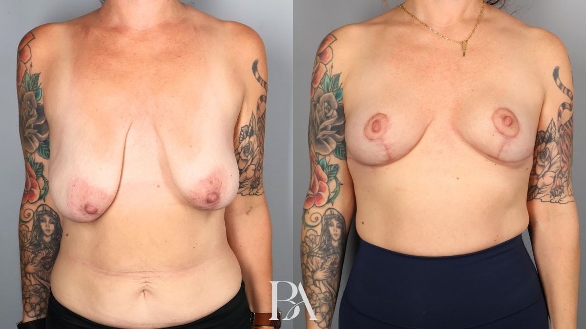 Before and after — Breast Lift (Mastopexy)