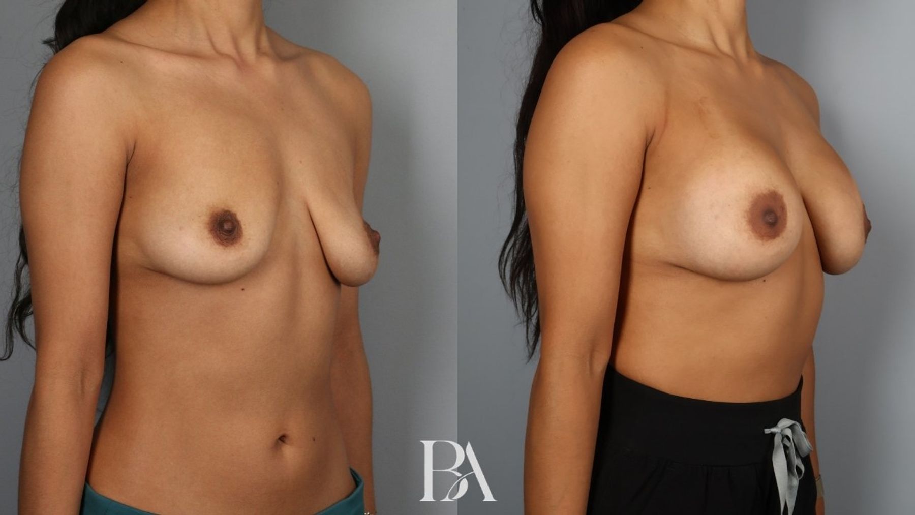 Breast augmentation before and after — oblique view, Dr. Beina Azadgoli, Beverly Hills