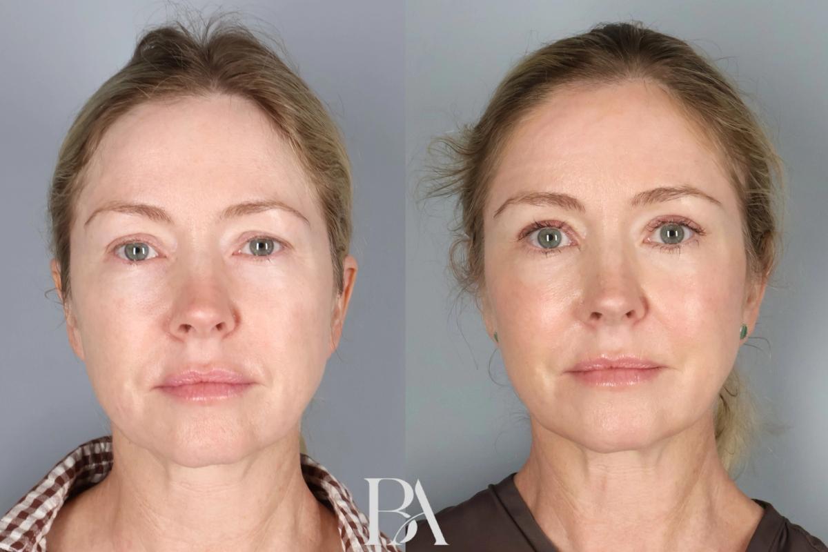 Before and after — Upper Blepharoplasty