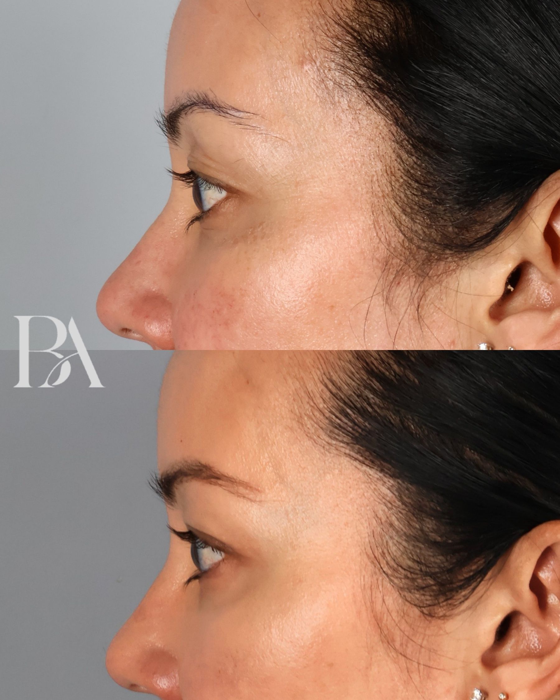 Upper Blepharoplasty before and after — side view, Dr. Beina Azadgoli, Beverly Hills
