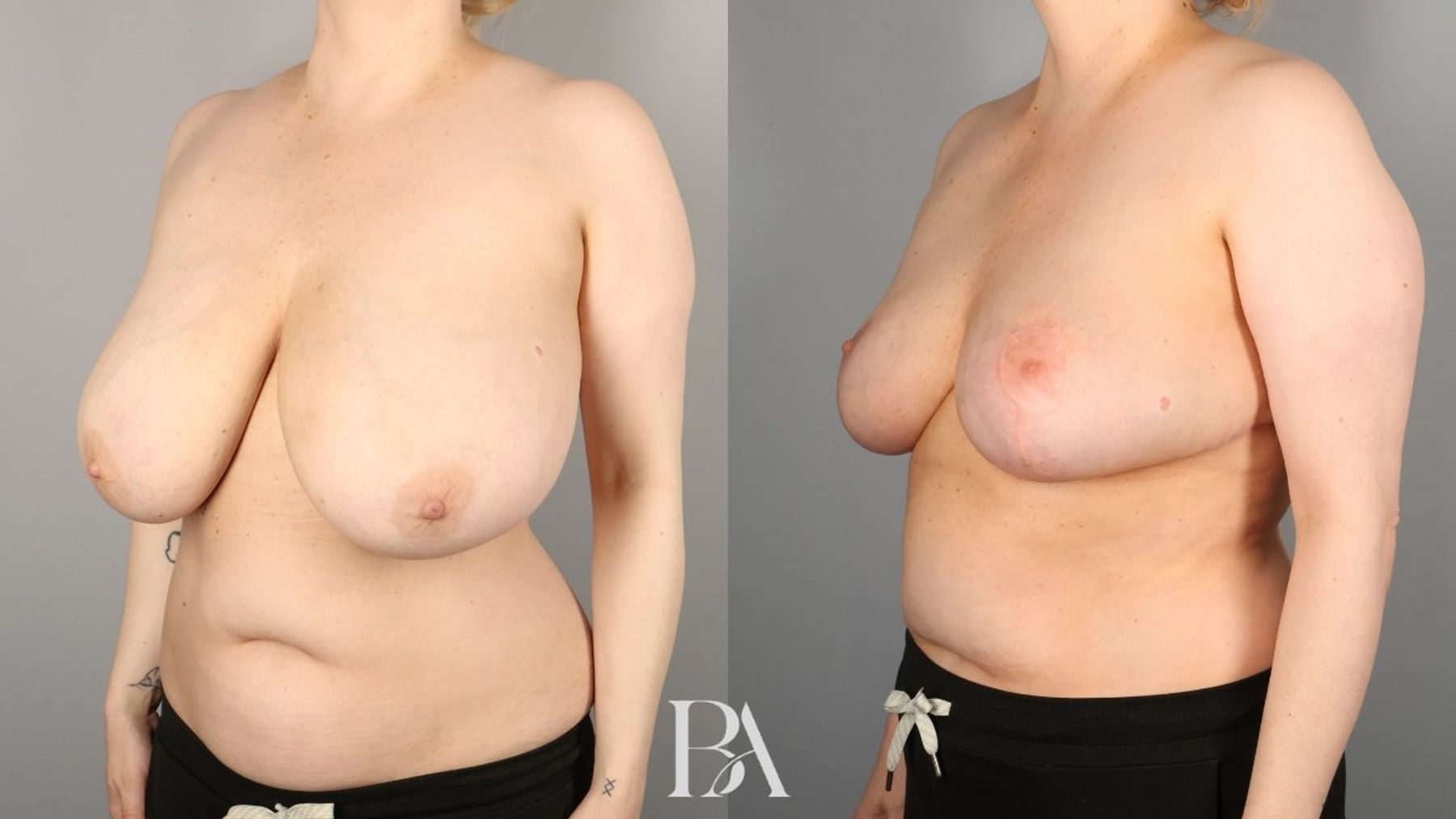 Oncoplastic Reduction before and after — three-quarter view, Dr. Beina Azadgoli, Beverly Hills