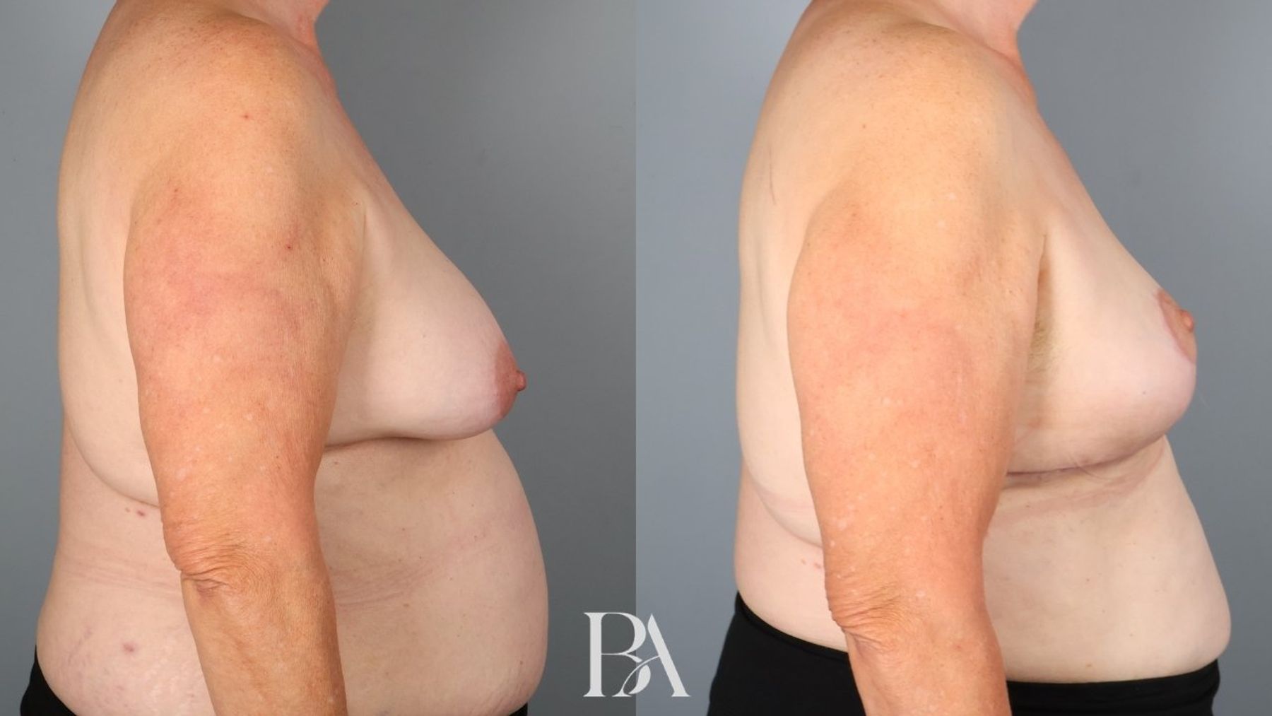 Oncoplastic Reduction before and after — side view, Dr. Beina Azadgoli, Beverly Hills