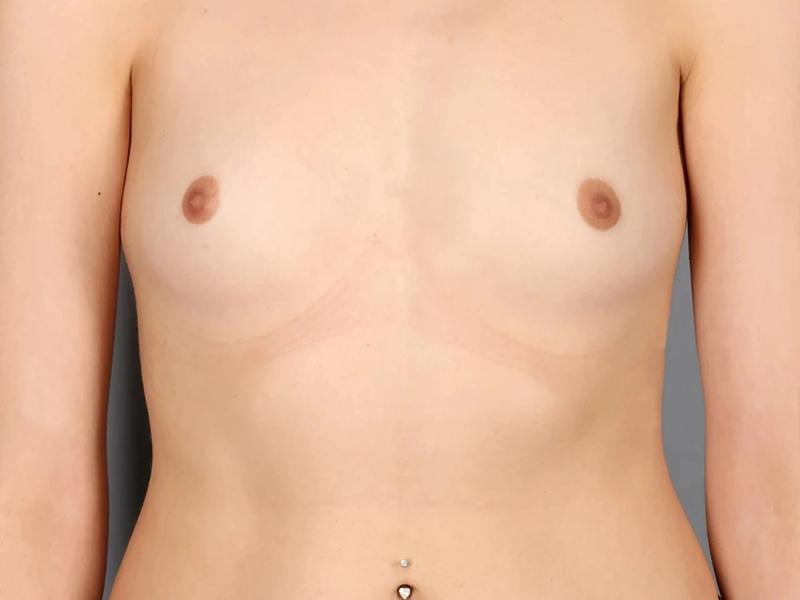 Before — Breast Augmentation