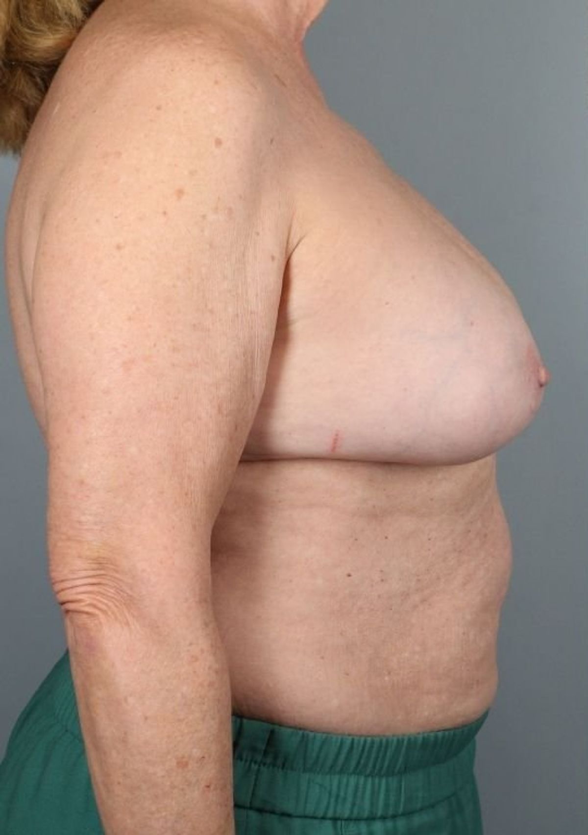 Breast implant removal before — detail view, Dr. Beina Azadgoli, Beverly Hills