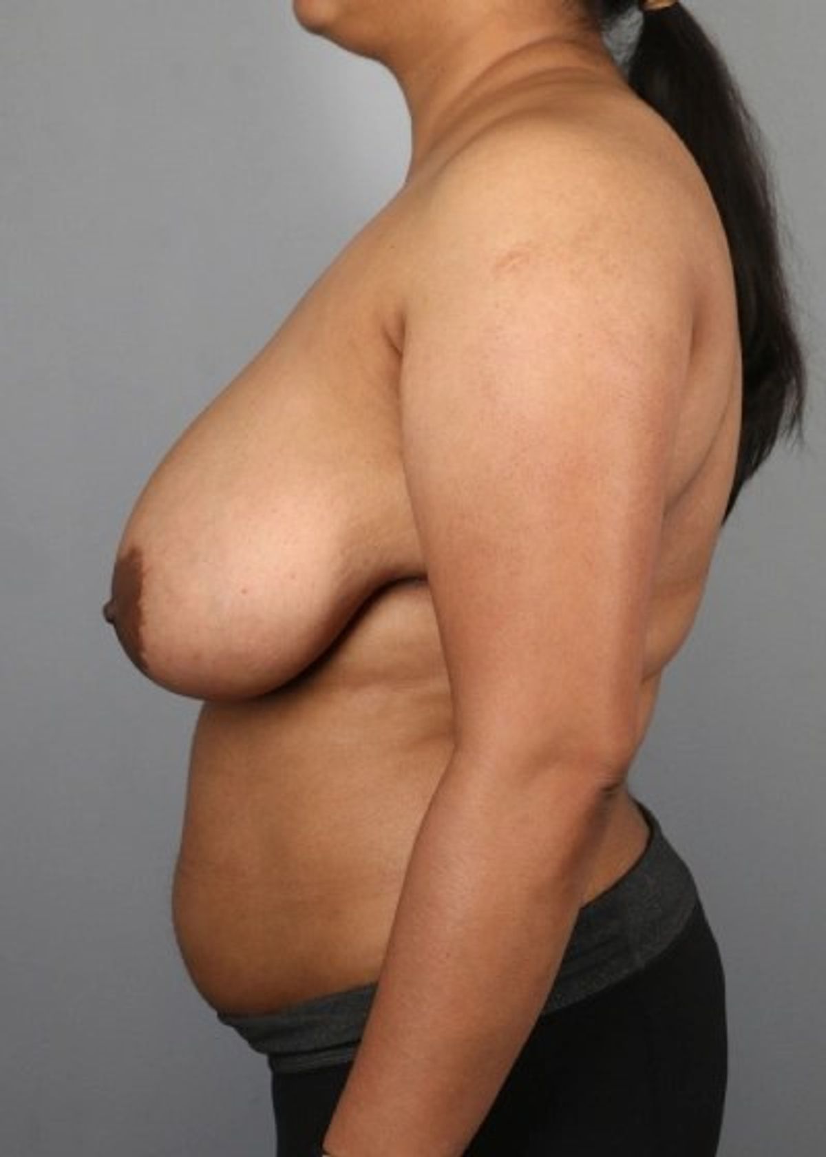 Case 1302 — Oblique before