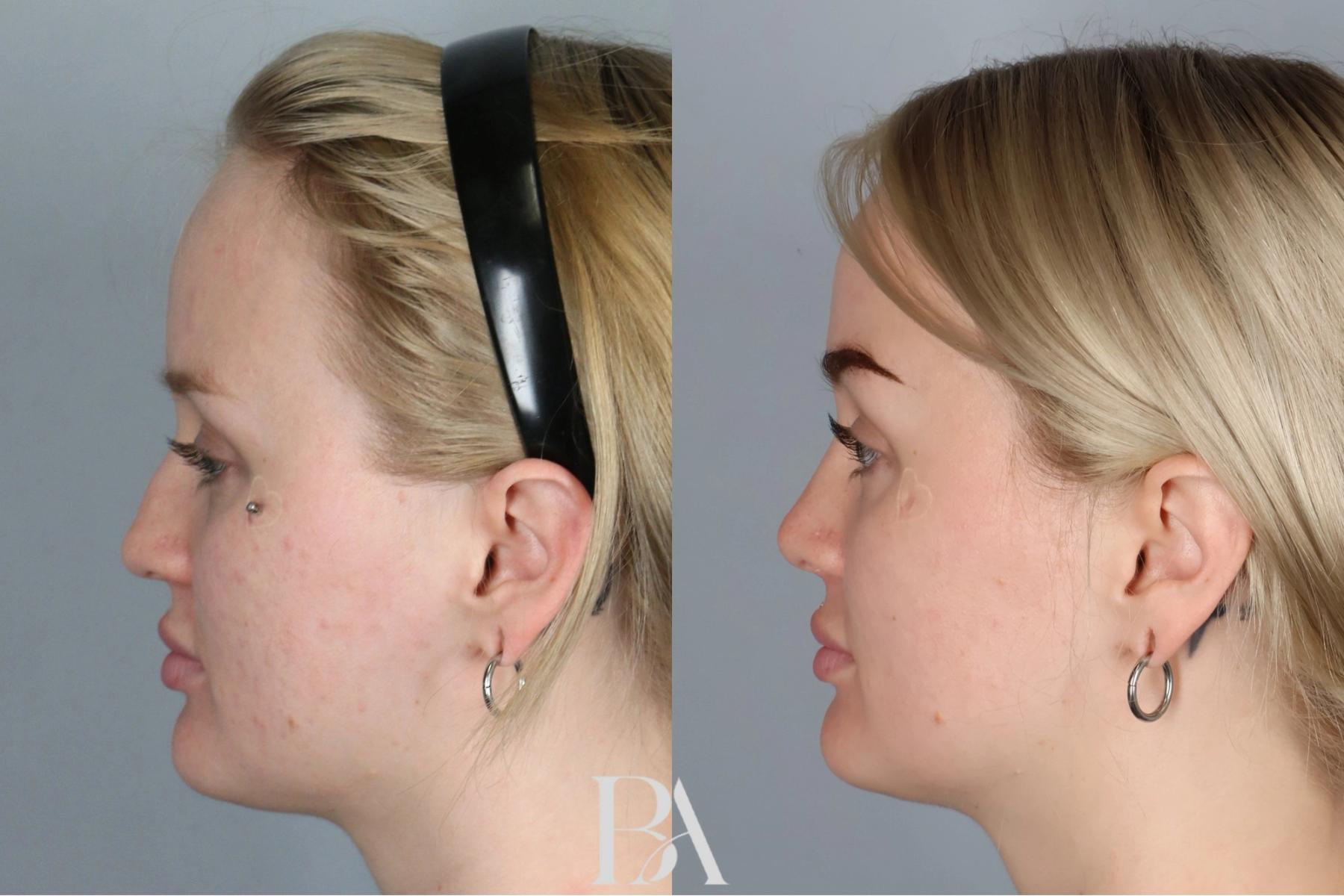 Rhinoplasty before and after — side view, Dr. Beina Azadgoli, Beverly Hills