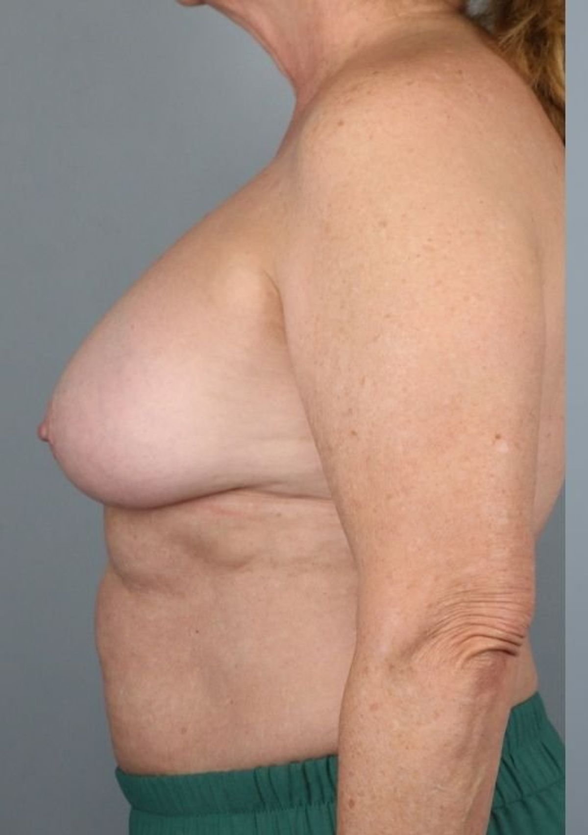 Breast implant removal before — side view, Dr. Beina Azadgoli, Beverly Hills